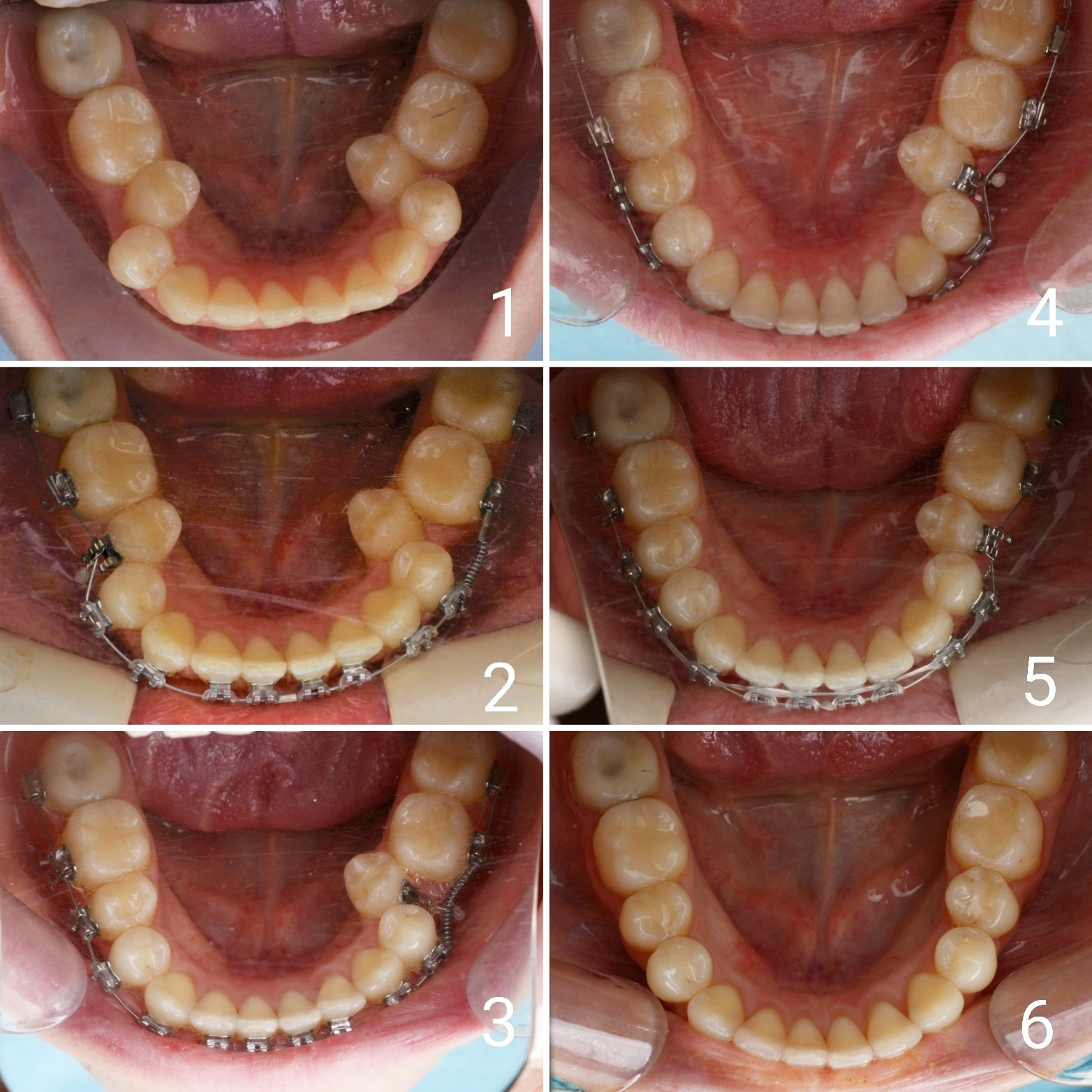 Блог врача. Стоматология «Ортодонт-Эстетик». Установка брекетов в Оренбурге, взрос