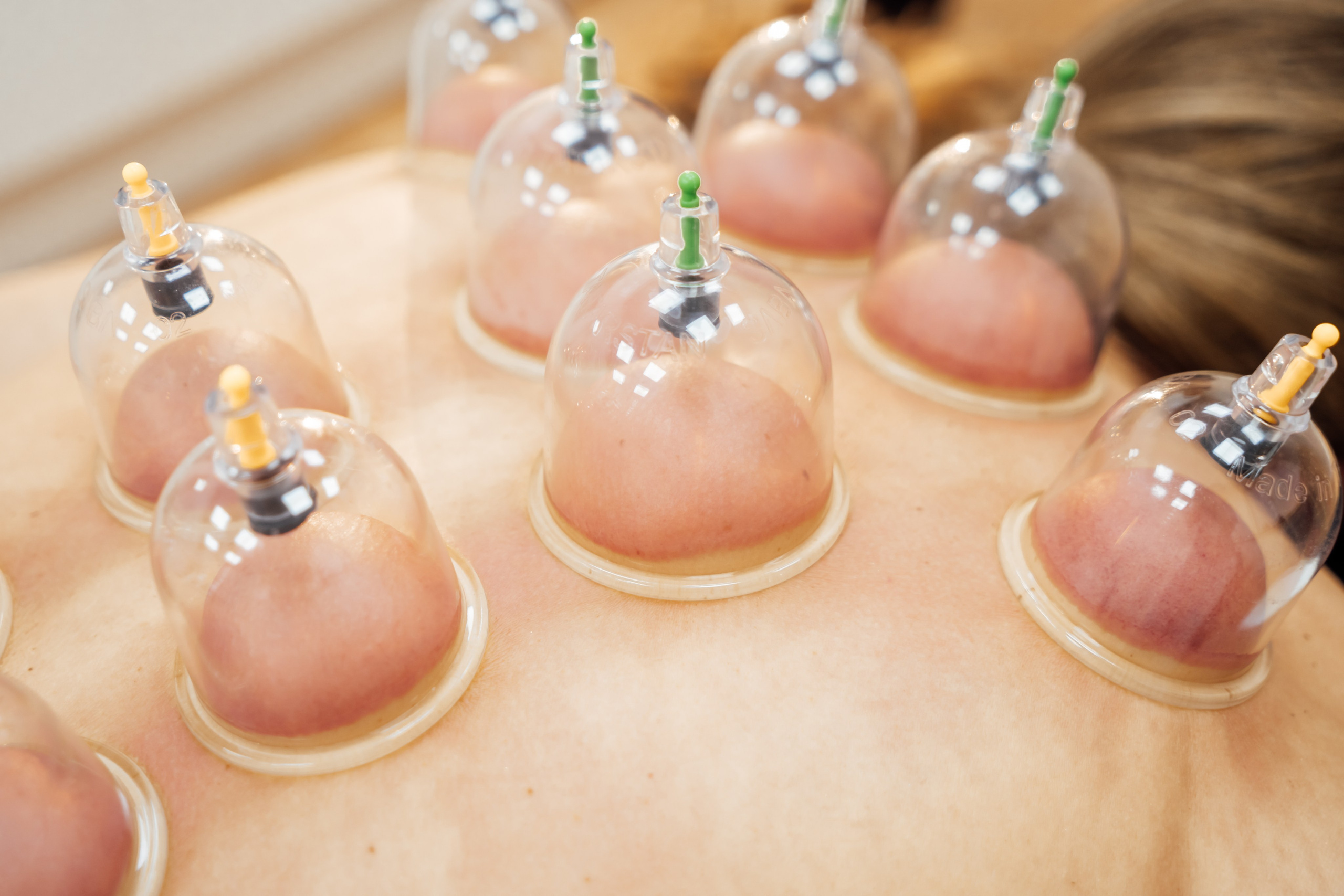 ВАККУМТЕРАПИЯ. Https://esmassage.ru