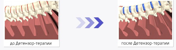 ДЕТЕНЗОР для лечения спины. Медицина с душой