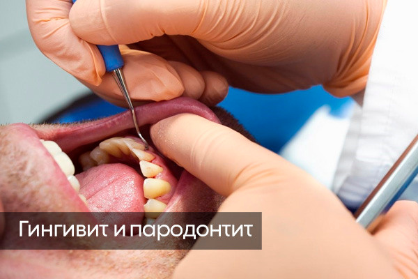 Гингивит и пародонтит