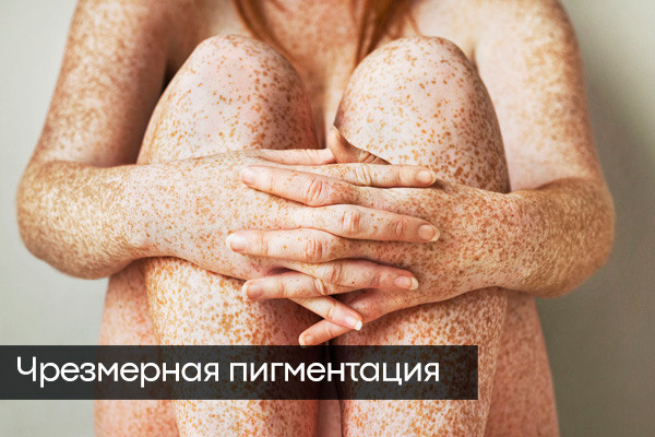 пигментация кожи