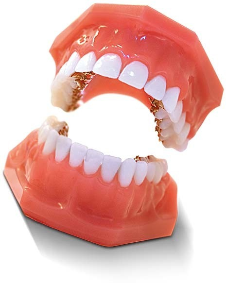 Лингвальные (внутренние) брекеты, которые не видны окружающим. Стоматология «Ортодонт-Эстетик». Установка брекетов в Оренбурге, взрос