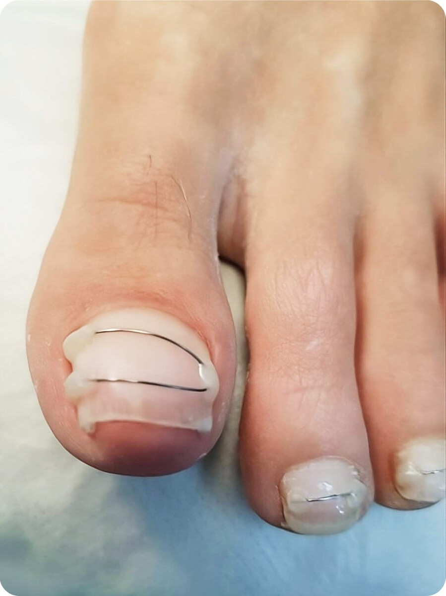 Курс Титановая нить. Подолог г. Хабаровск — центр здоровой стопы «FOOTTIME»