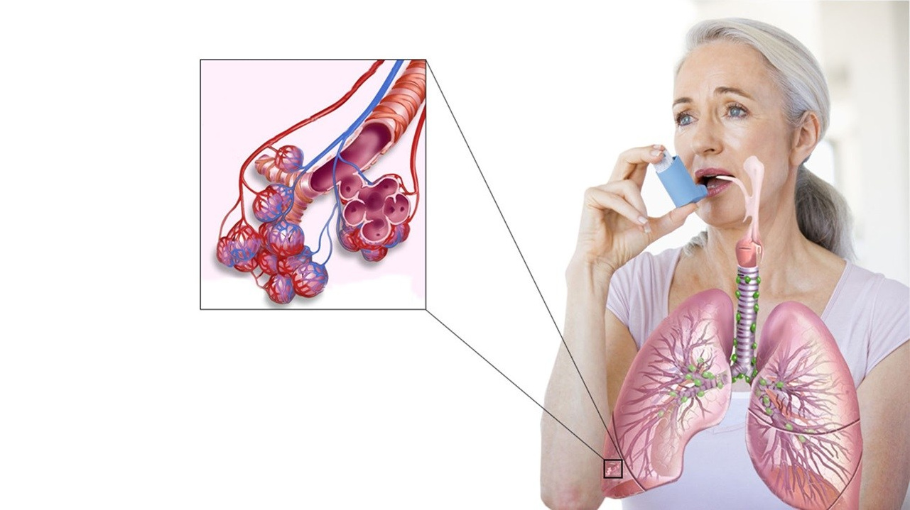 Аллергический бронхит -  какими препаратами компании Сово-Сова лечить