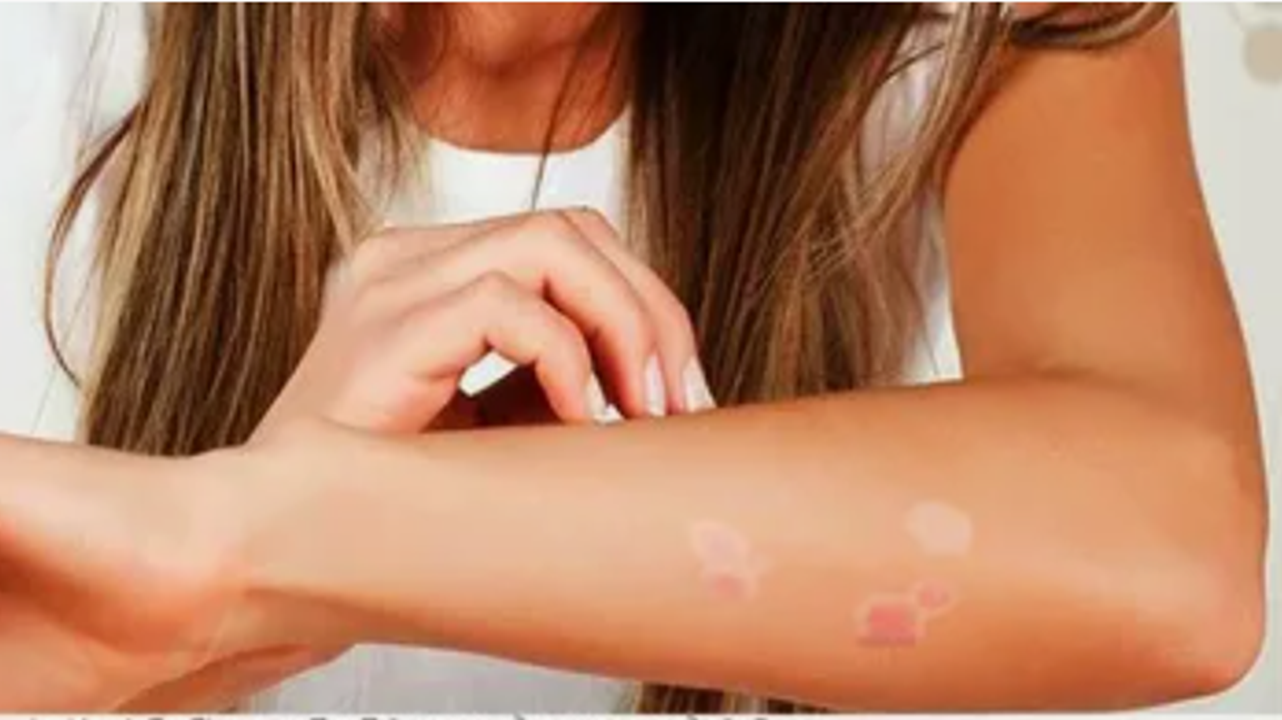 Псориаз чем лечить. Какими препаратами компании Сово-Сова лечить псориаз.  Что поможет при псориазе из препаратов компании Сово-Сова