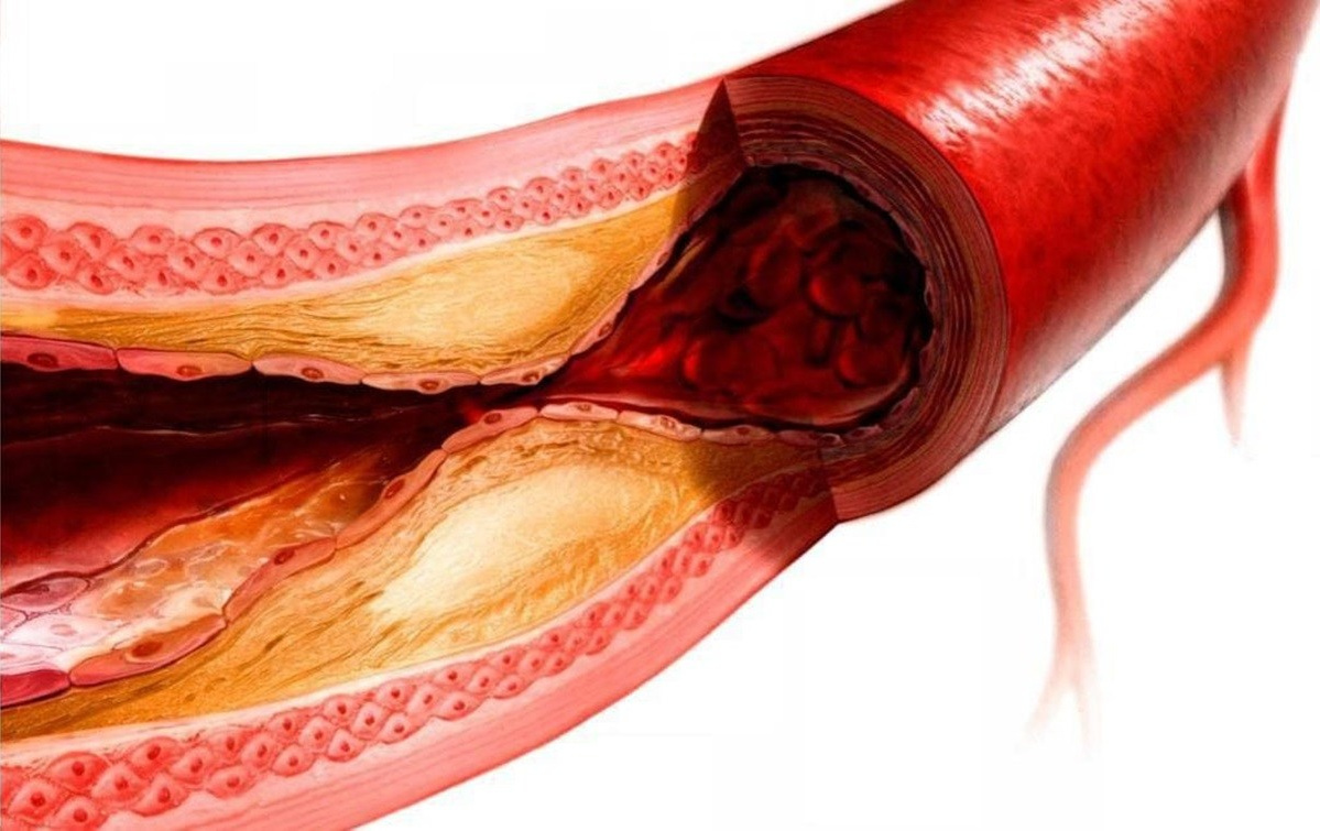 Болезни кровеносных сосудов. Как решить проблемы кровеносных сосудов . Чем лечить болезни кровеносных сосудов