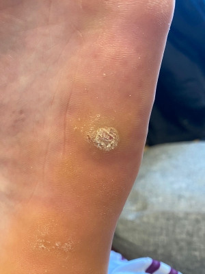 Бородавка. Подолог г. Хабаровск — центр здоровой стопы «FOOTTIME»