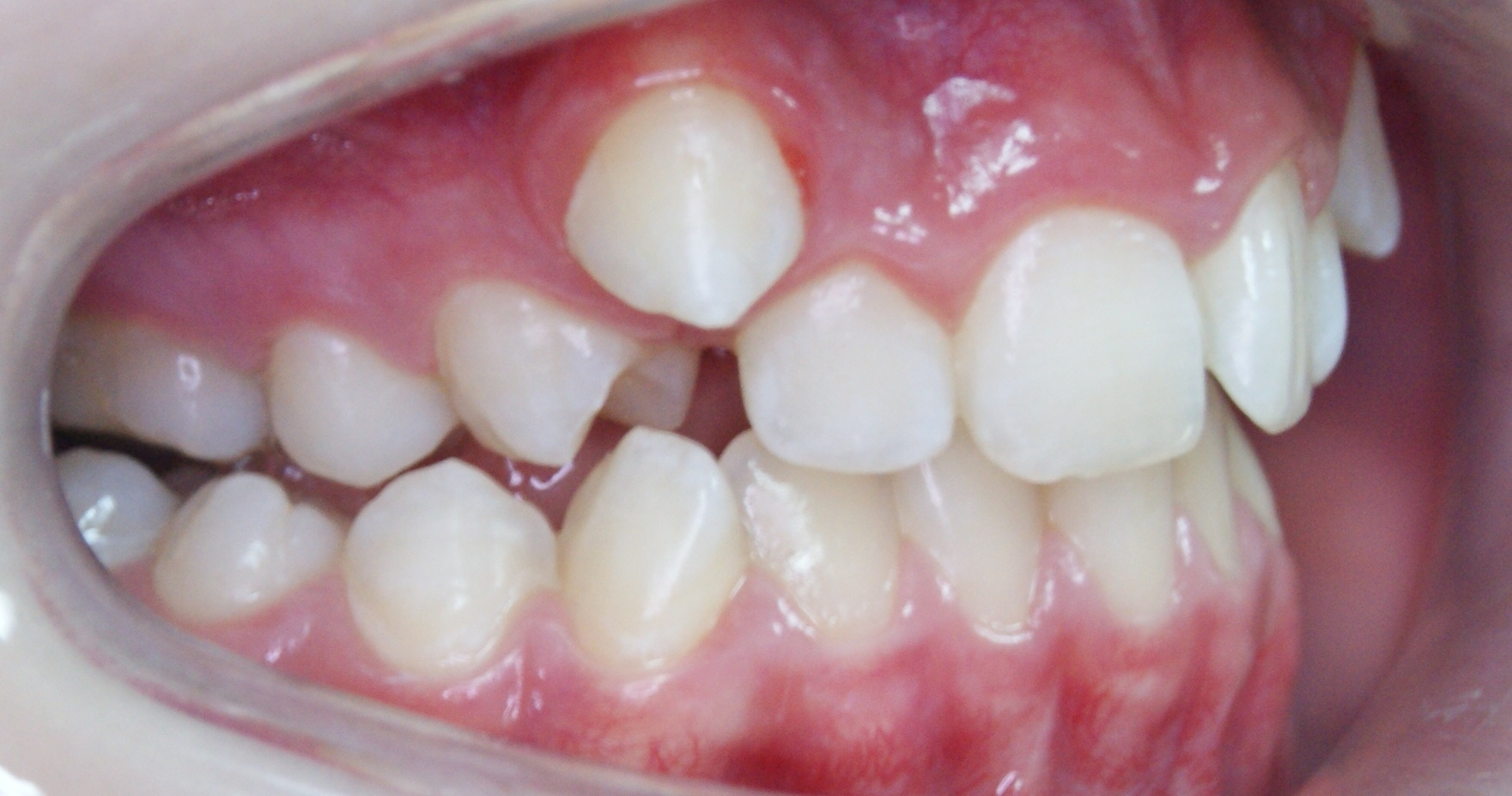 Результаты работ до/после и замечательные улыбки. Стоматология «Ортодонт-Эстетик». Установка брекетов в Оренбурге, взрос