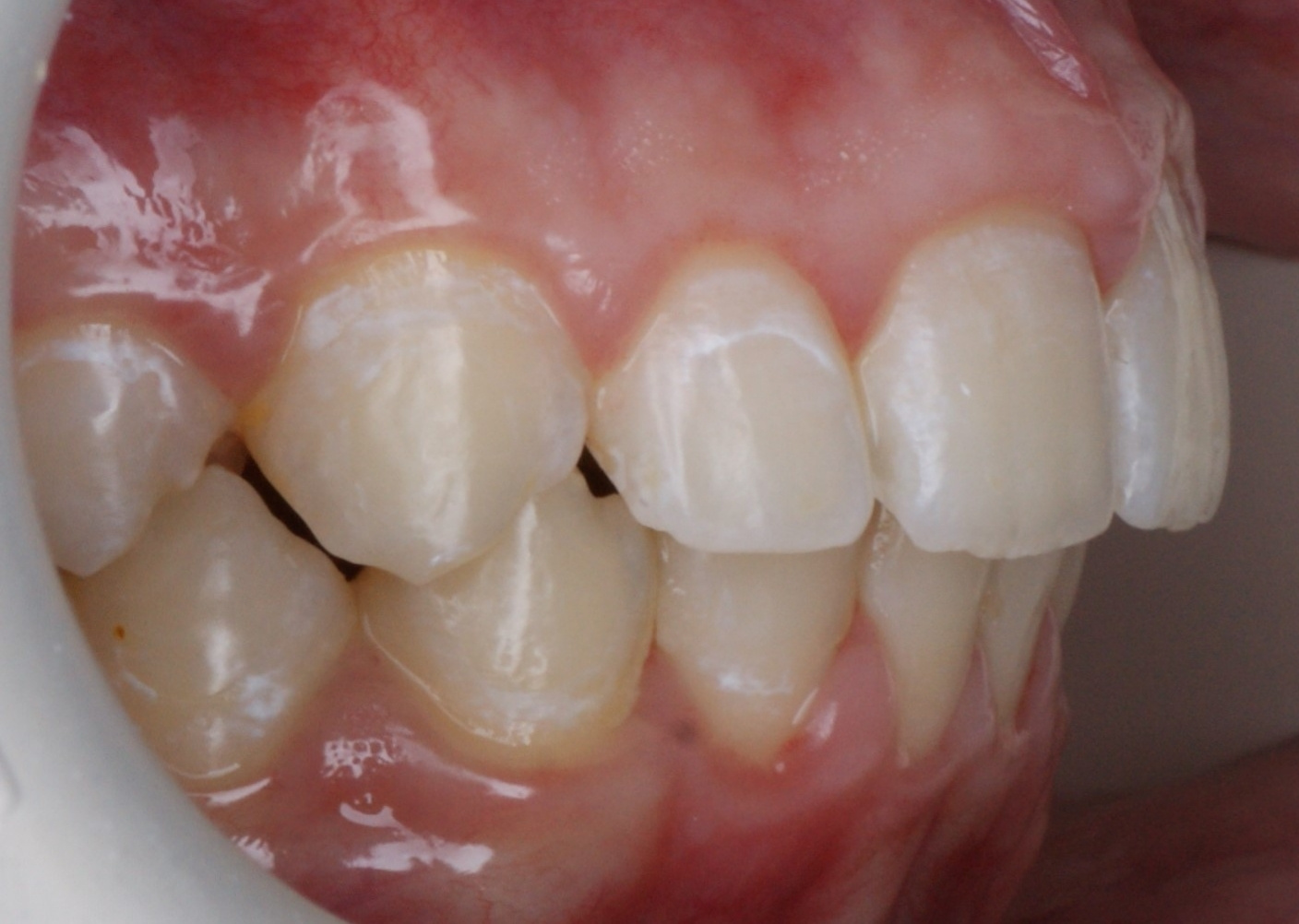 Результаты работ до/после и замечательные улыбки. Стоматология «Ортодонт-Эстетик». Установка брекетов в Оренбурге, взрос