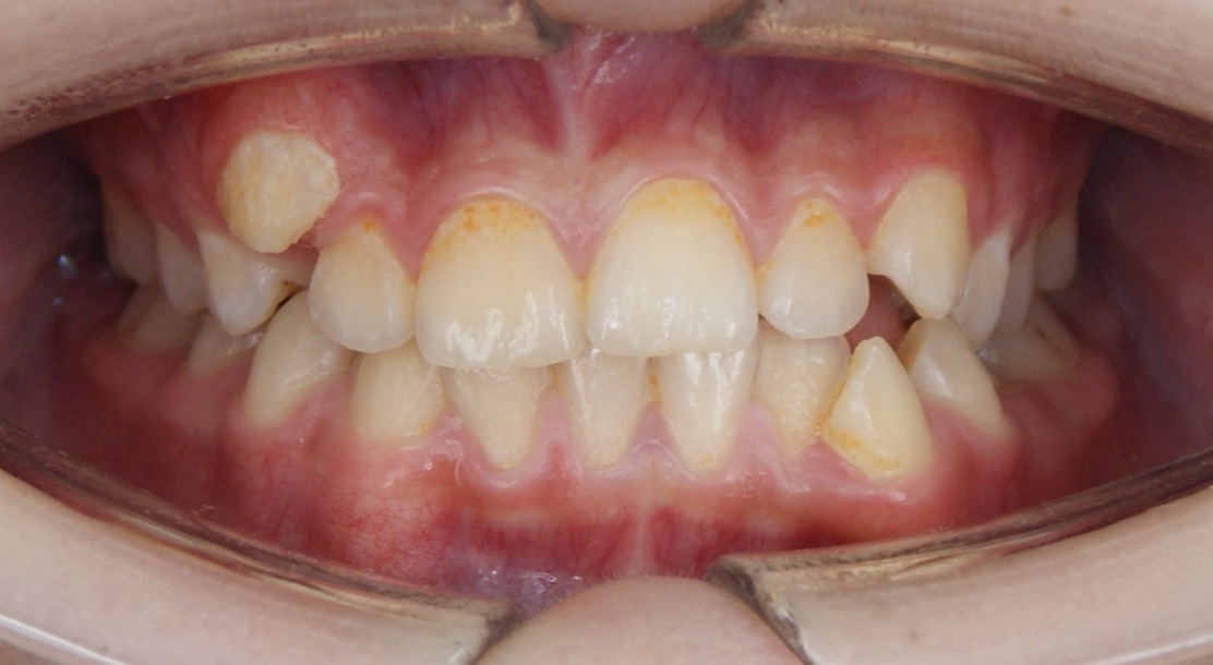 Результаты работ до/после и замечательные улыбки. Стоматология «Ортодонт-Эстетик». Установка брекетов в Оренбурге, взрос