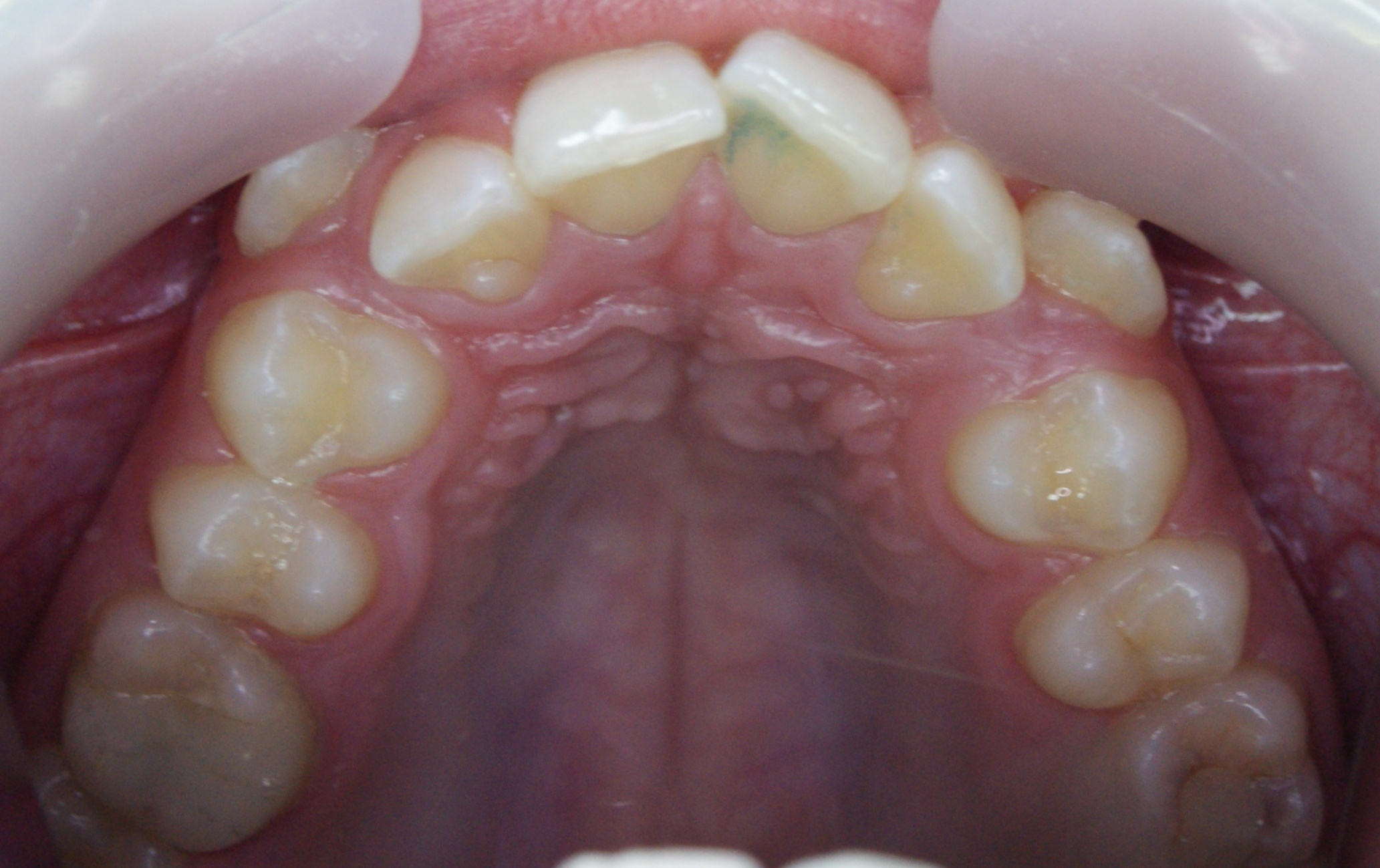 Результаты работ до/после и замечательные улыбки. Стоматология «Ортодонт-Эстетик». Установка брекетов в Оренбурге, взрос