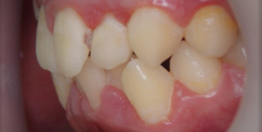 Результаты работ до/после и замечательные улыбки. Стоматология «Ортодонт-Эстетик». Установка брекетов в Оренбурге, взрос