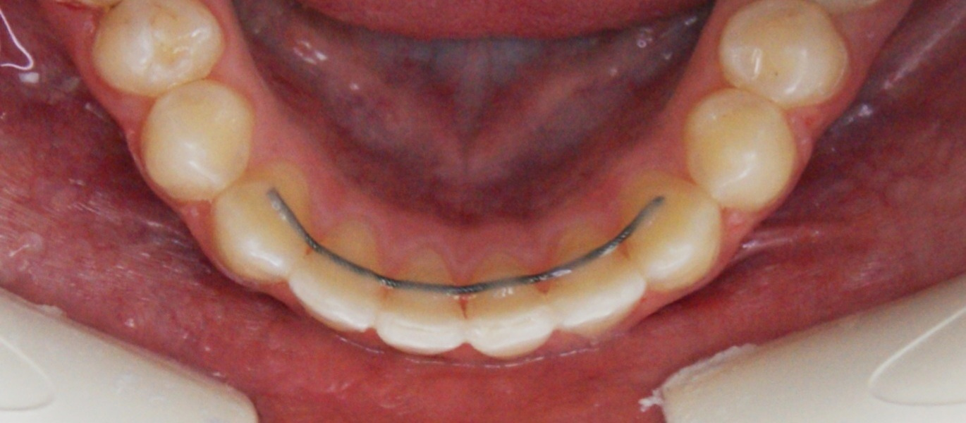 Результаты работ до/после и замечательные улыбки. Стоматология «Ортодонт-Эстетик». Установка брекетов в Оренбурге, взрос