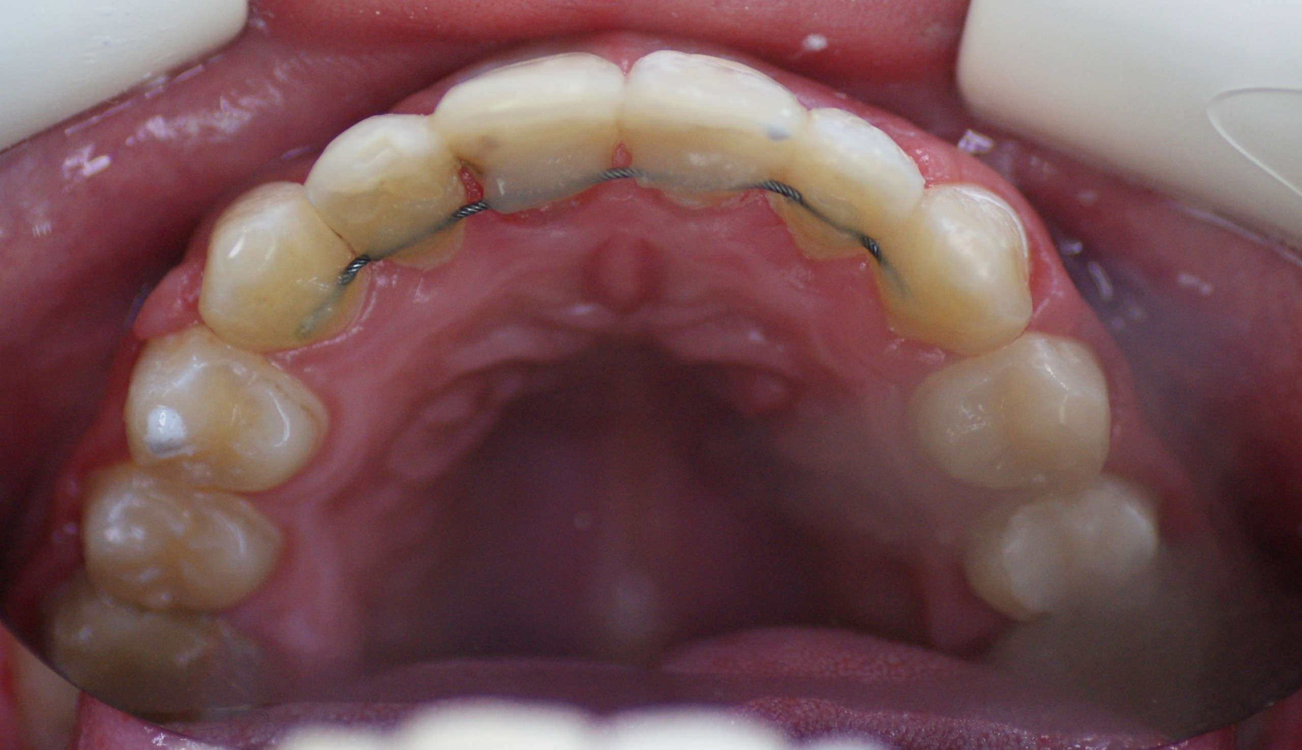 Результаты работ до/после и замечательные улыбки. Стоматология «Ортодонт-Эстетик». Установка брекетов в Оренбурге, взрос