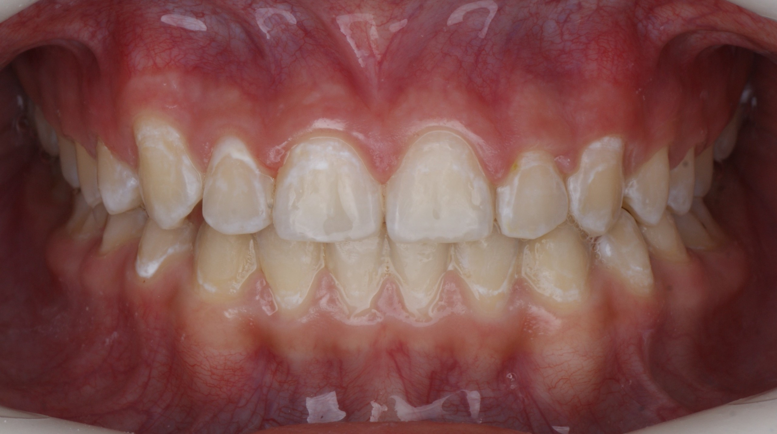 Результаты работ до/после и замечательные улыбки. Стоматология «Ортодонт-Эстетик». Установка брекетов в Оренбурге, взрос