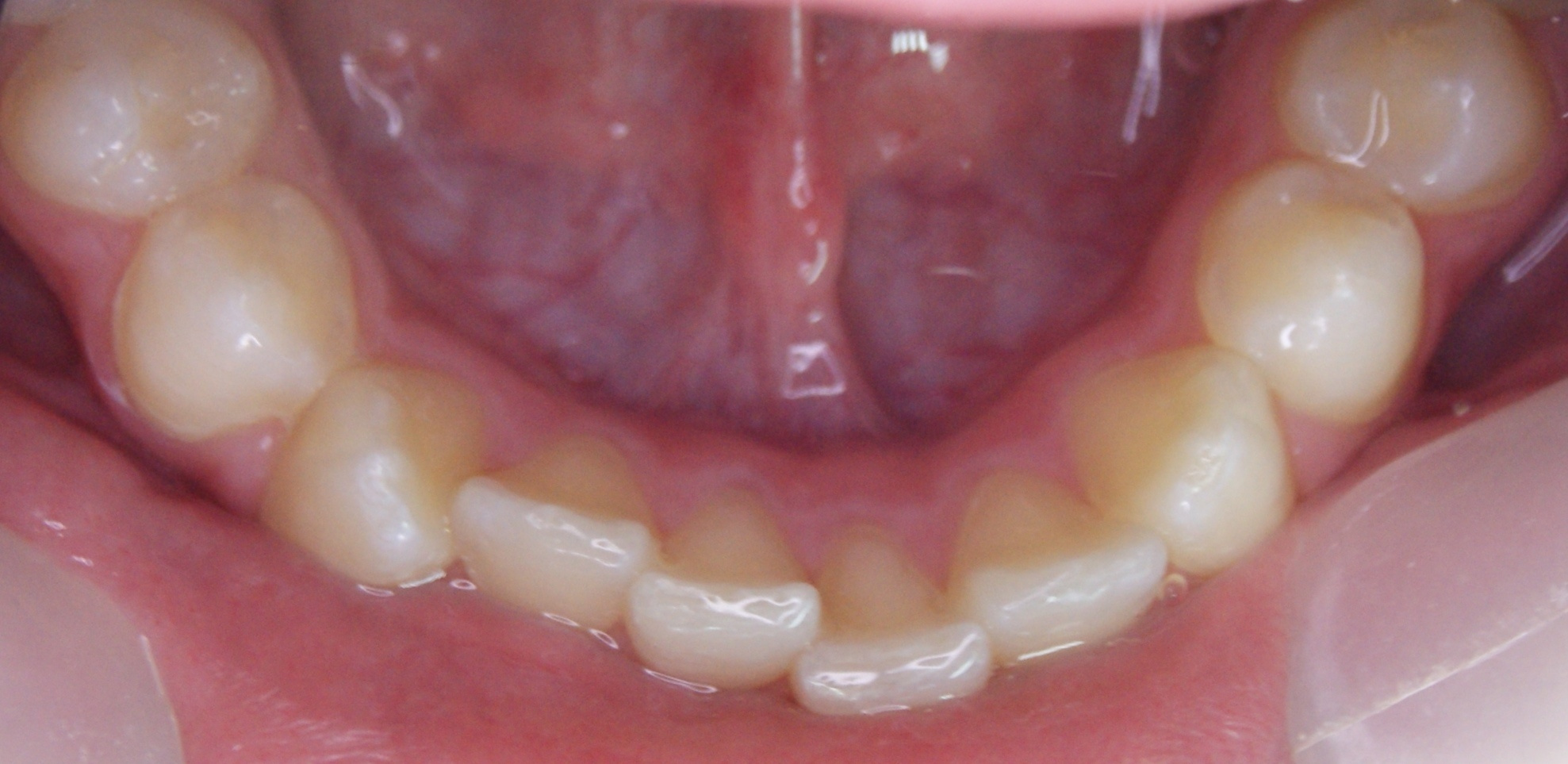 Результаты работ до/после и замечательные улыбки. Стоматология «Ортодонт-Эстетик». Установка брекетов в Оренбурге, взрос