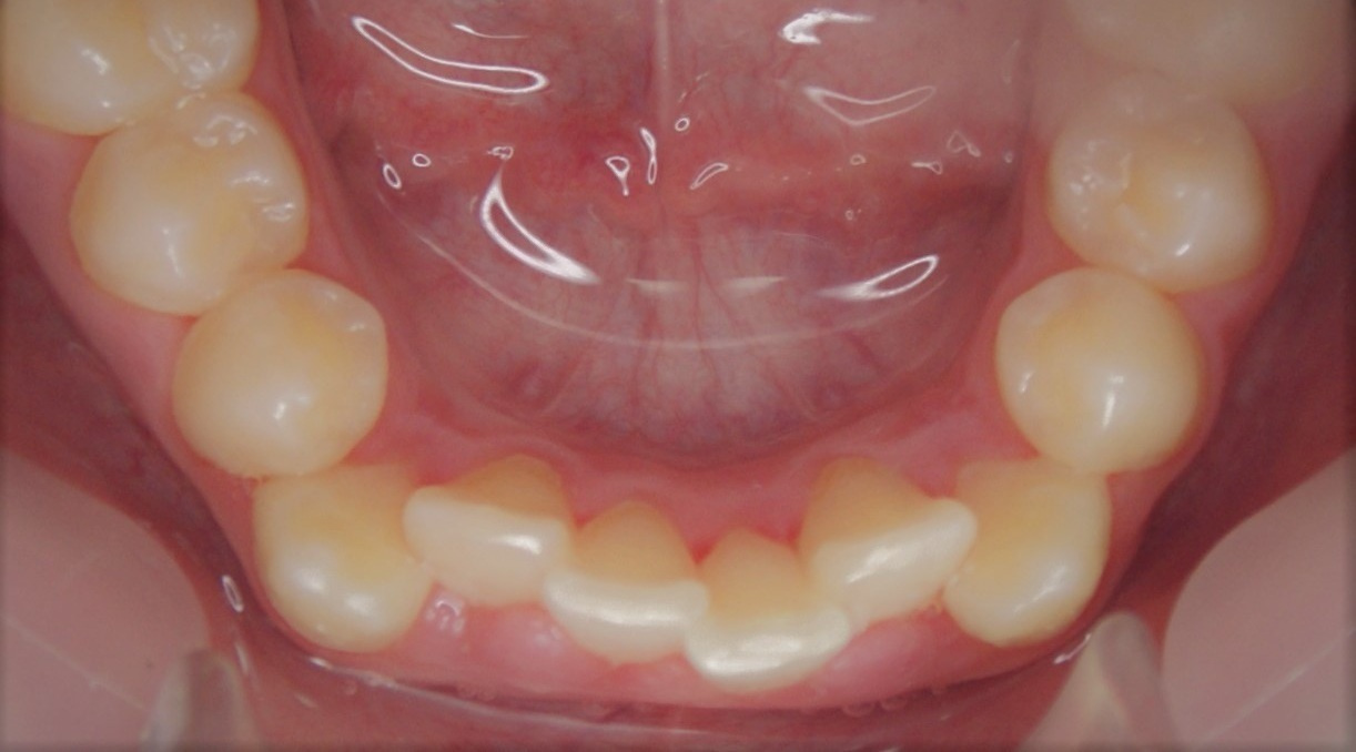 Результаты работ до/после и замечательные улыбки. Стоматология «Ортодонт-Эстетик». Установка брекетов в Оренбурге, взрос