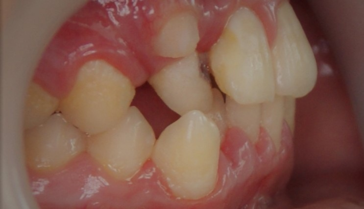 Результаты работ до/после и замечательные улыбки. Стоматология «Ортодонт-Эстетик». Установка брекетов в Оренбурге, взрос