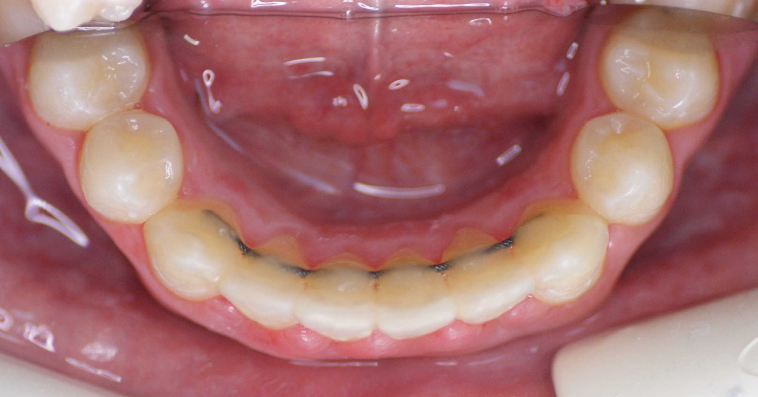 Результаты работ до/после и замечательные улыбки. Стоматология «Ортодонт-Эстетик». Установка брекетов в Оренбурге, взрос