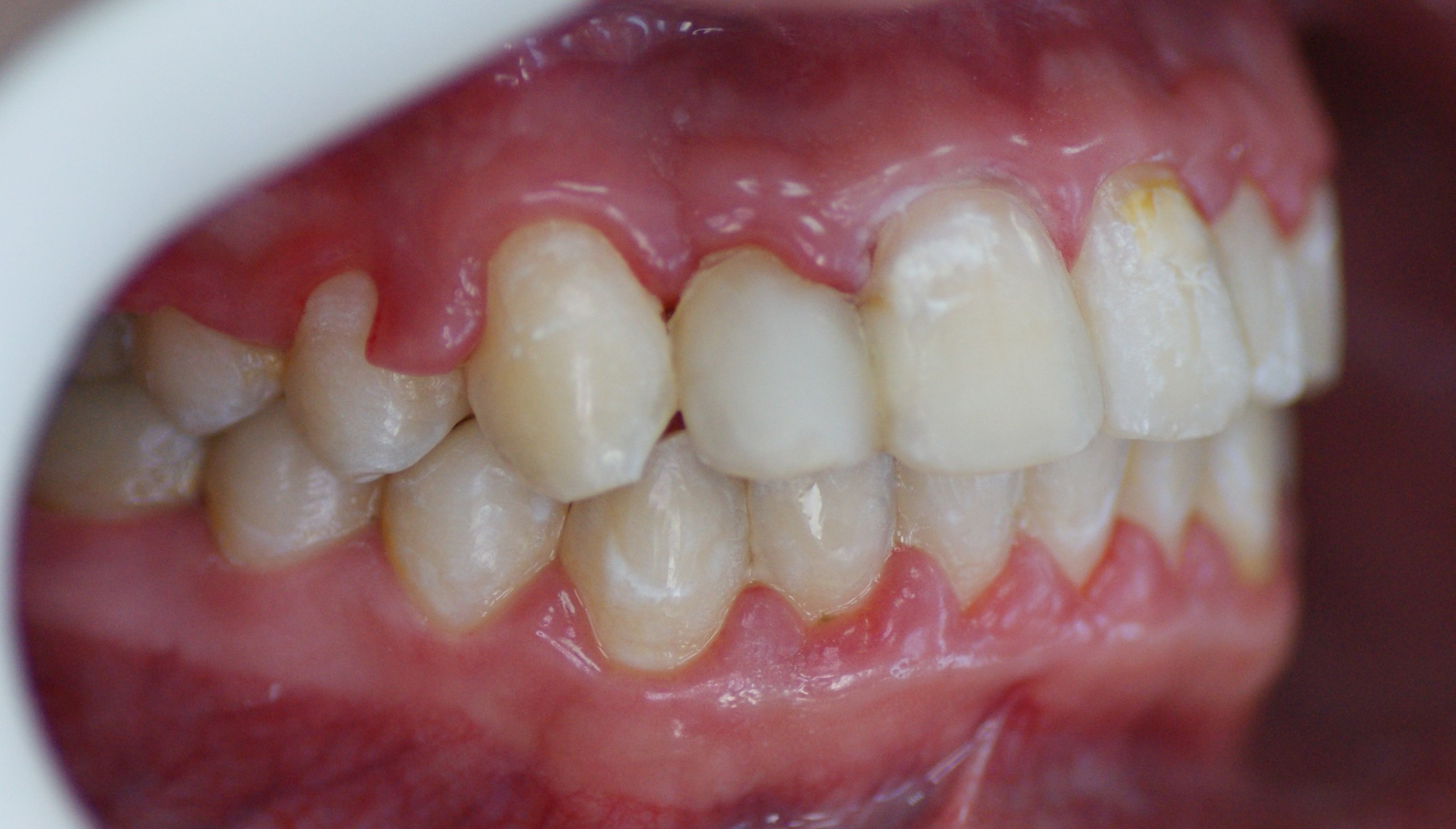 Результаты работ до/после и замечательные улыбки. Стоматология «Ортодонт-Эстетик». Установка брекетов в Оренбурге, взрос