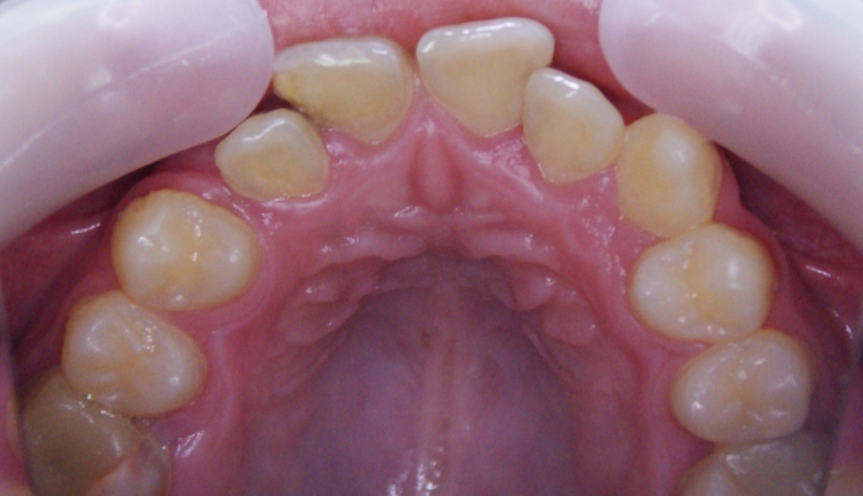 Результаты работ до/после и замечательные улыбки. Стоматология «Ортодонт-Эстетик». Установка брекетов в Оренбурге, взрос