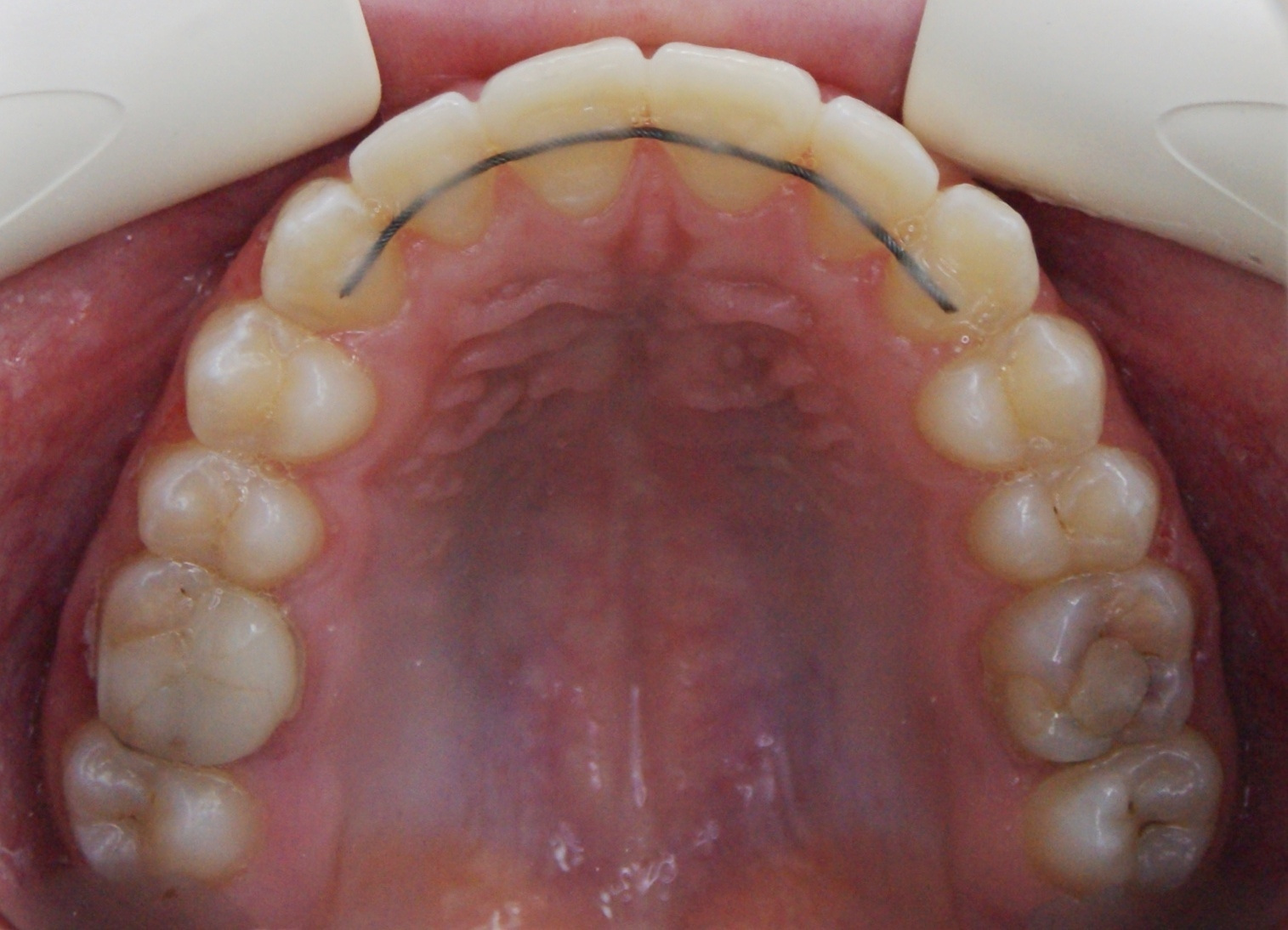 Результаты работ до/после и замечательные улыбки. Стоматология «Ортодонт-Эстетик». Установка брекетов в Оренбурге, взрос
