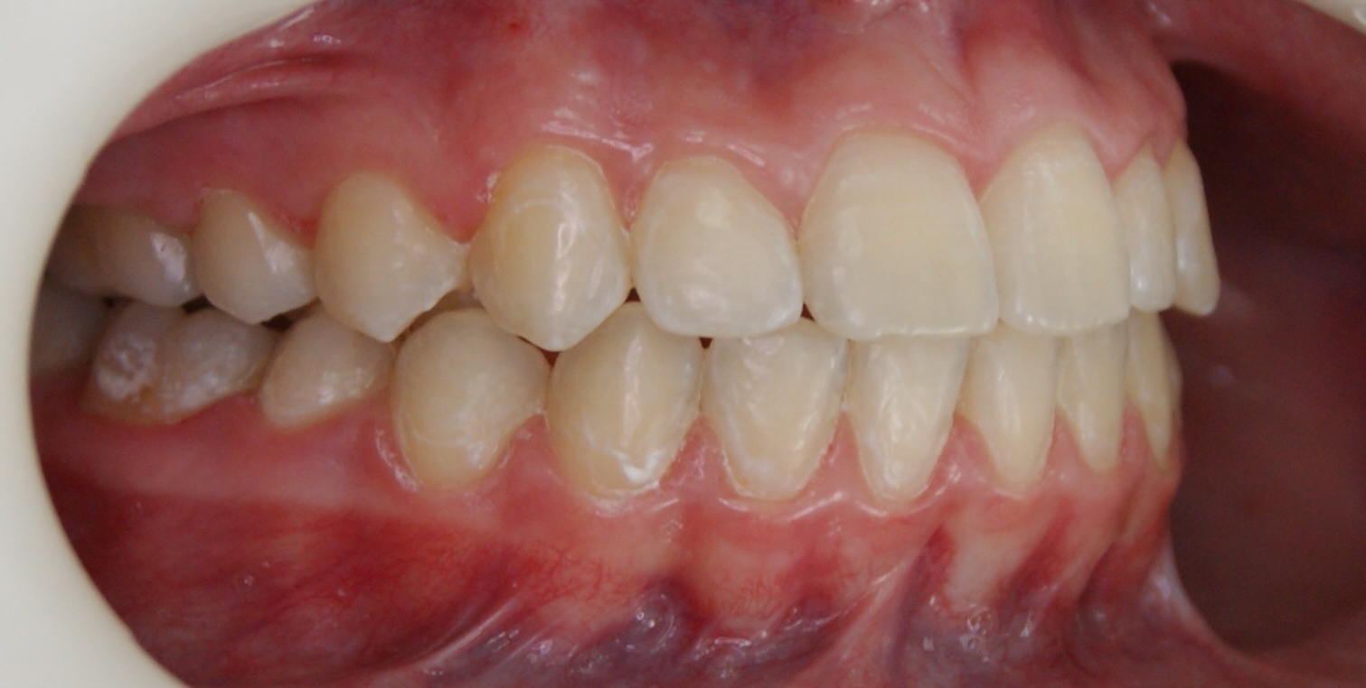 Результаты работ до/после и замечательные улыбки. Стоматология «Ортодонт-Эстетик». Установка брекетов в Оренбурге, взрос