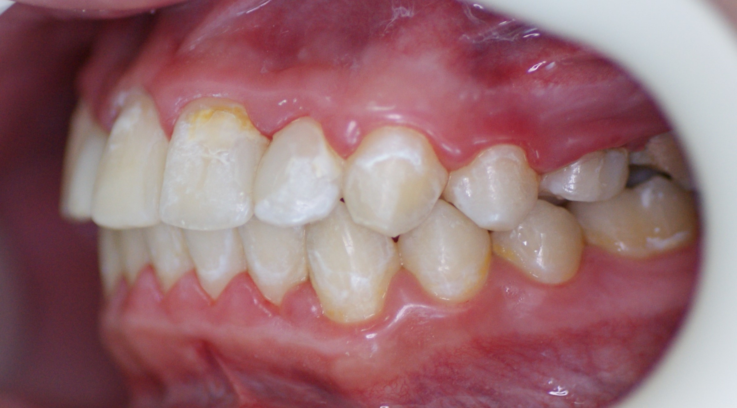 Результаты работ до/после и замечательные улыбки. Стоматология «Ортодонт-Эстетик». Установка брекетов в Оренбурге, взрос