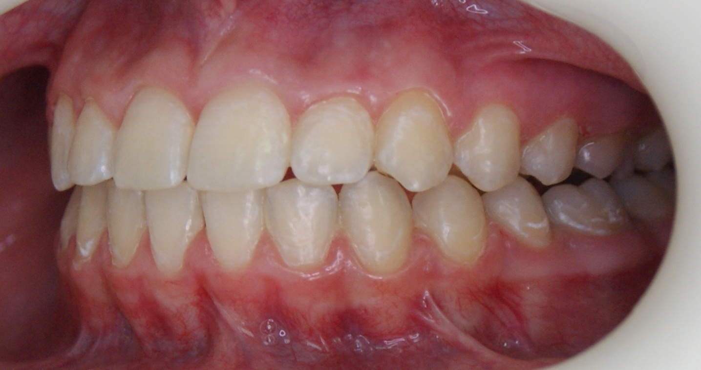 Результаты работ до/после и замечательные улыбки. Стоматология «Ортодонт-Эстетик». Установка брекетов в Оренбурге, взрос