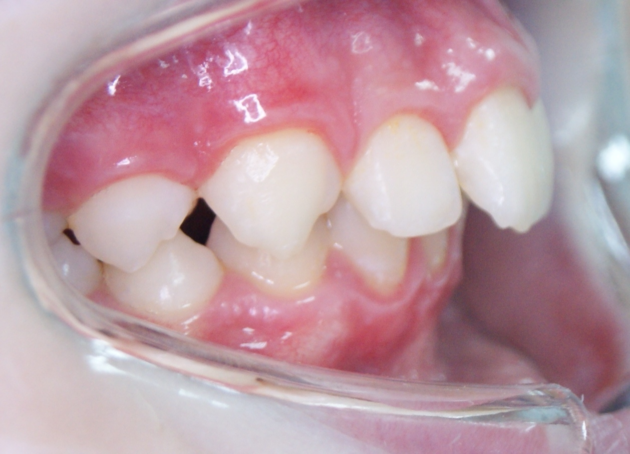 Результаты работ до/после и замечательные улыбки. Стоматология «Ортодонт-Эстетик». Установка брекетов в Оренбурге, взрос