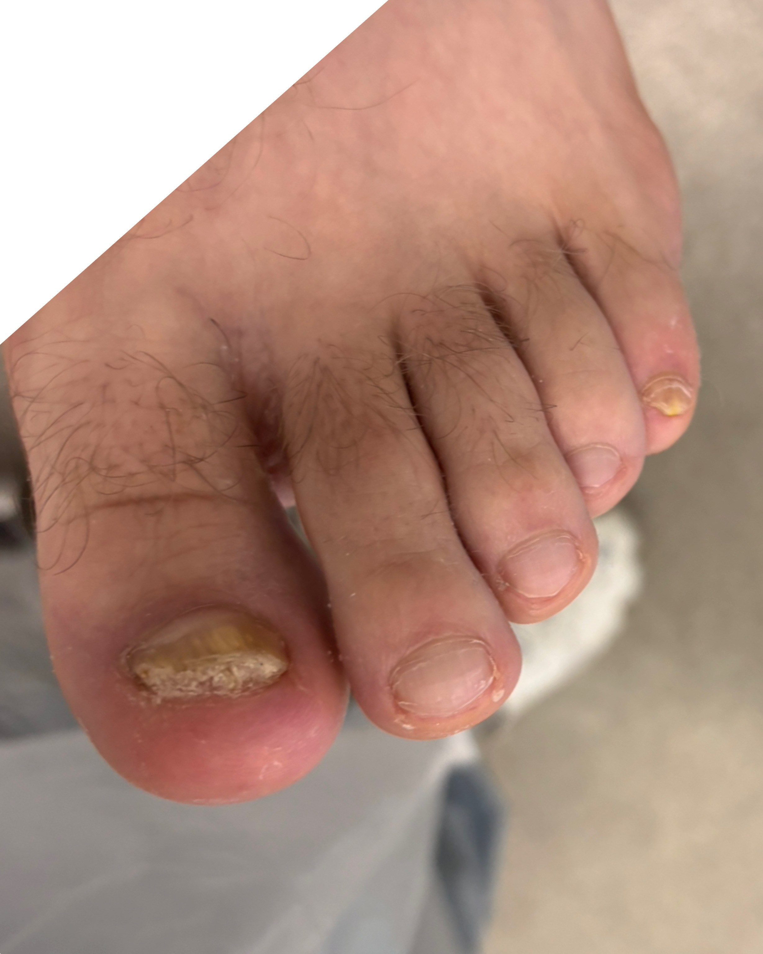 Обработка стопы при грибке. Подолог г. Хабаровск — центр здоровой стопы «FOOTTIME»