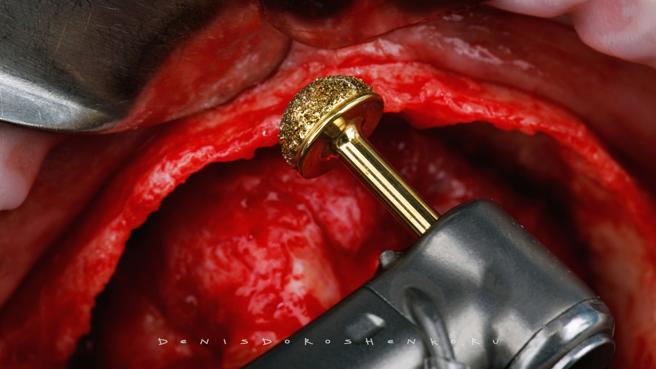 Хирургия. Дентал фотограф — видеограф Денис Дорошенко