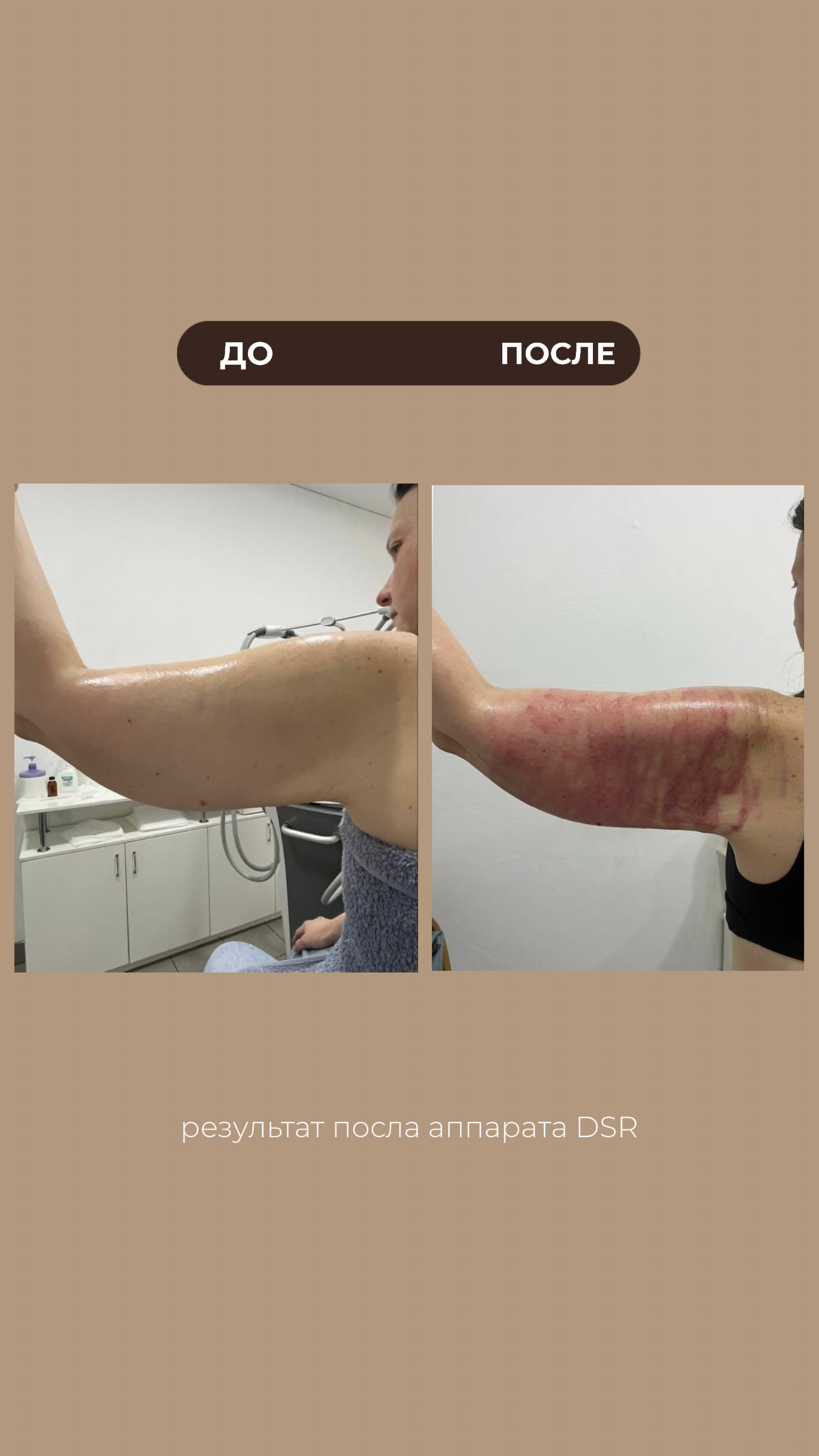 РЕЗУЛЬТАТЫ КЛИЕНТОВ ДО/ПОСЛЕ. Центр аппаратной косметологии IVI