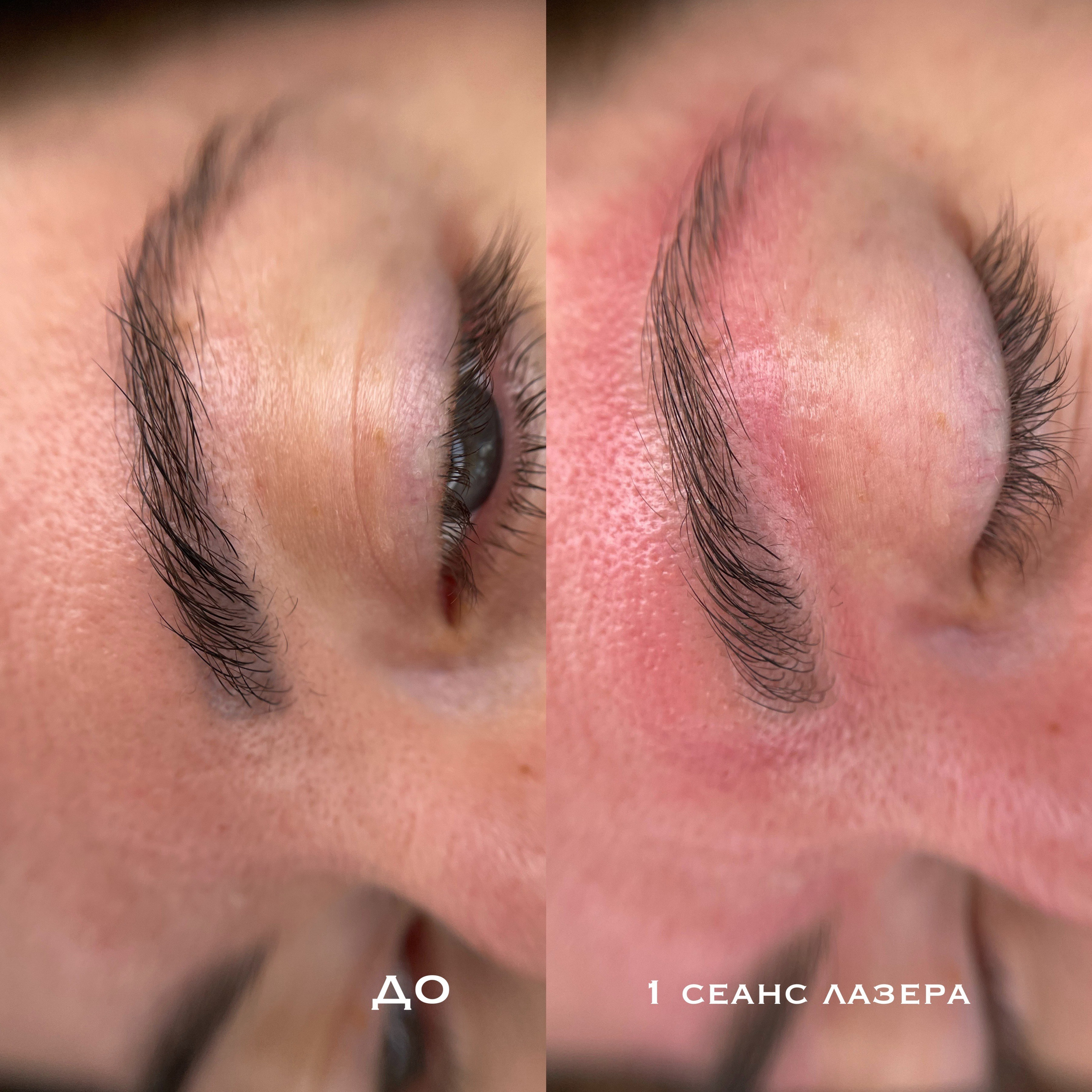 УДАЛЕНИЕ СТАРОГО ТАТУАЖА. Перманентный макияж и удаление старого татуажа в Ростове-на-Дону Дарья Исакова