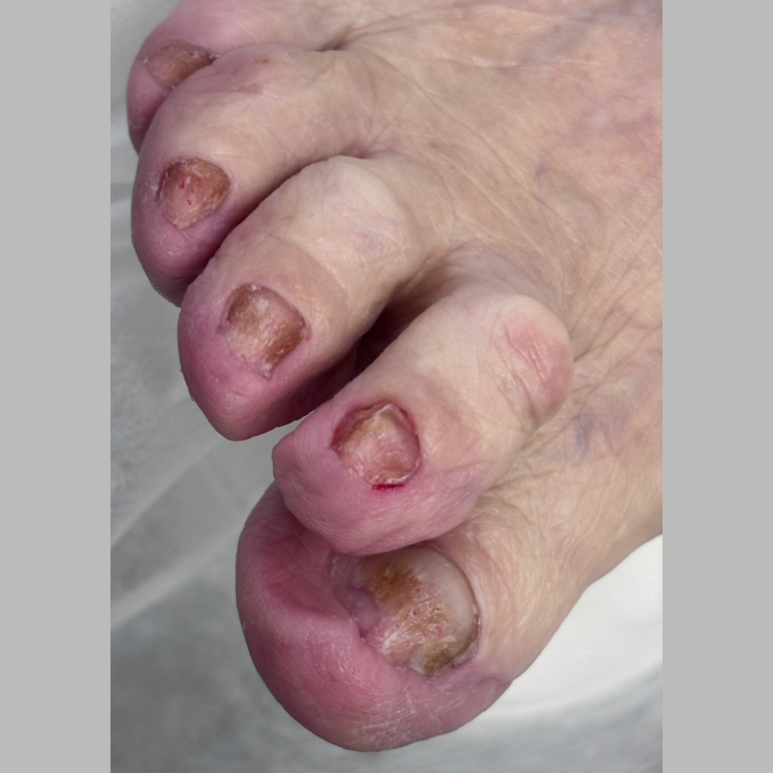 Тотальный онихомикоз. Подолог г. Хабаровск — центр здоровой стопы «FOOTTIME»