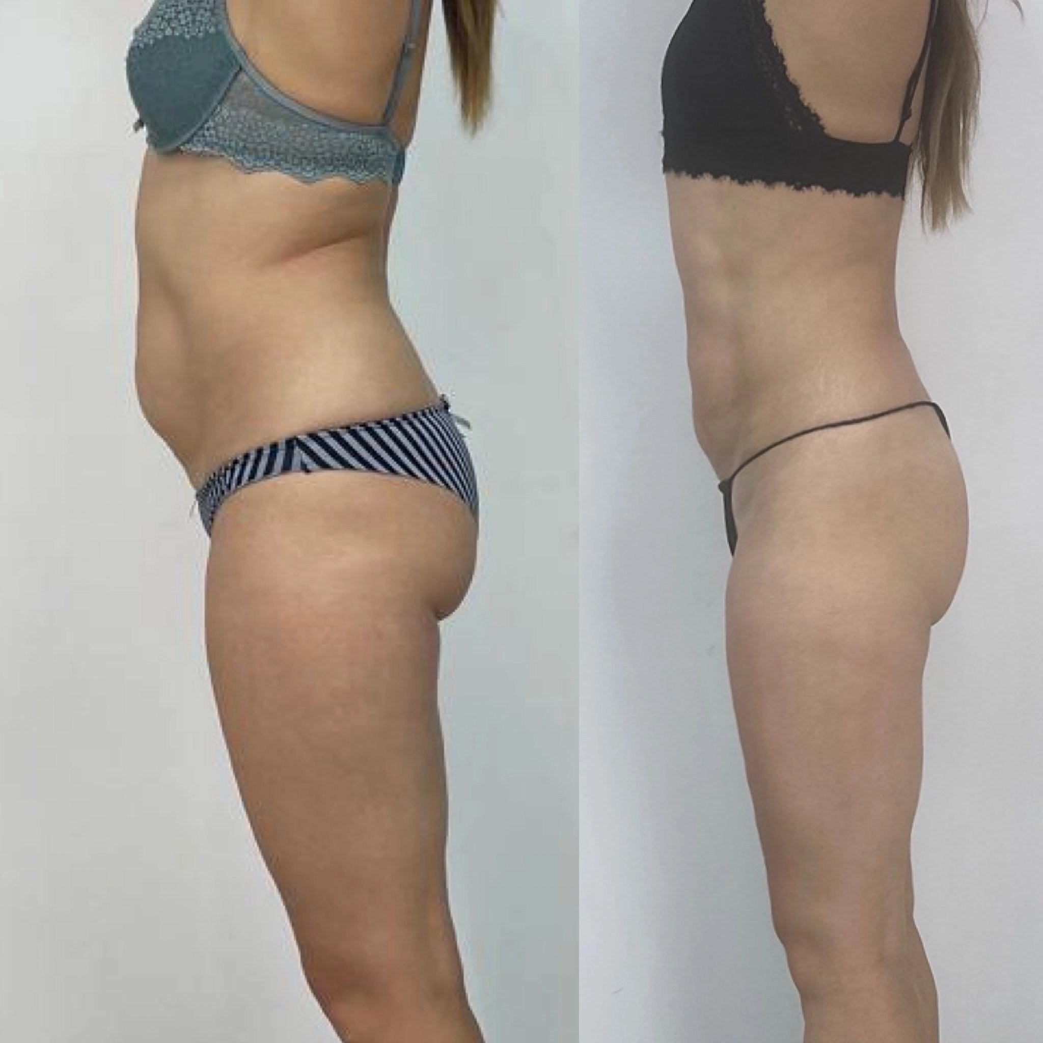 Результаты. Центр Коррекции Тела в городе Чехов