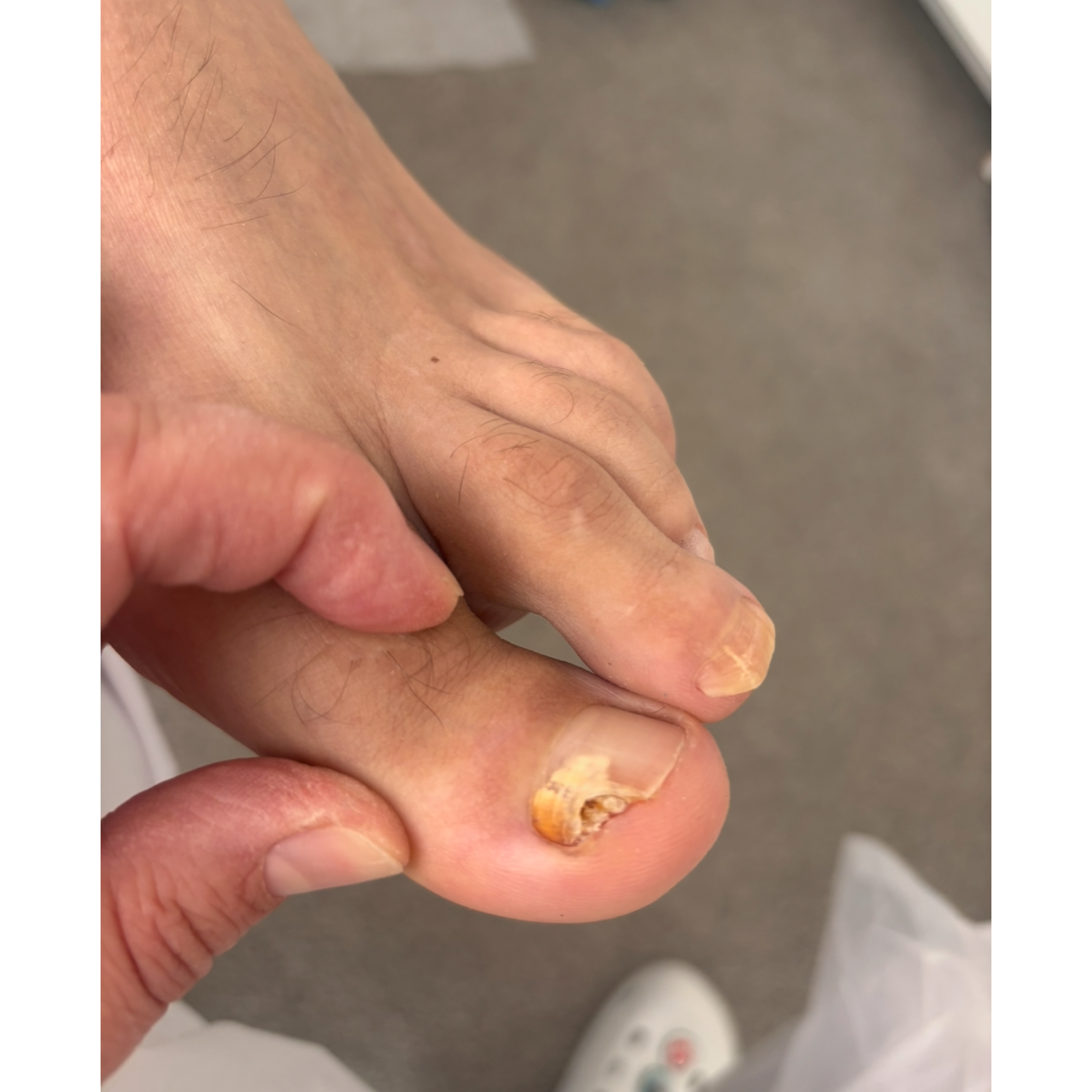 Динамика онихомикоз. Подолог г. Хабаровск — центр здоровой стопы «FOOTTIME»