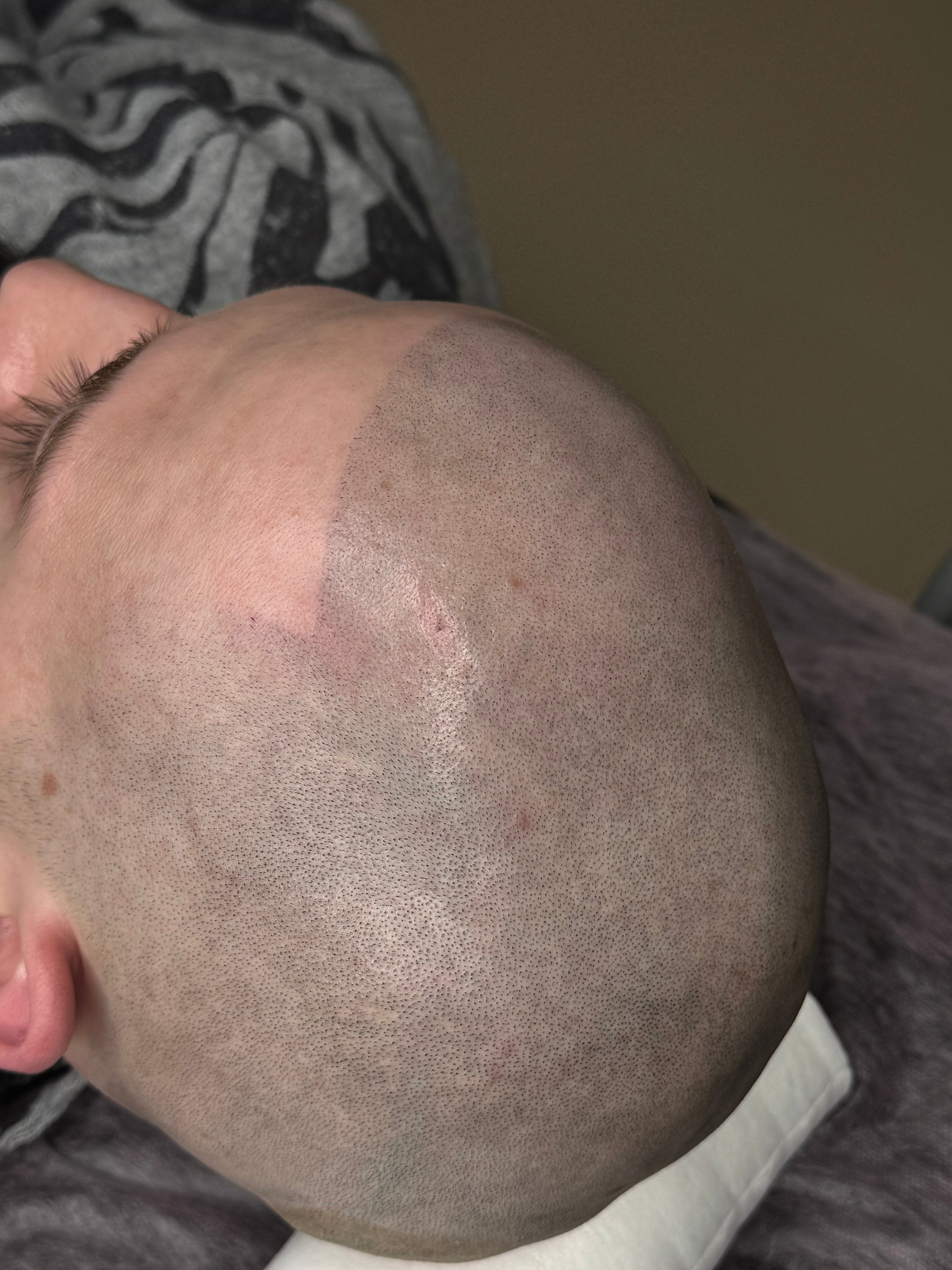 Нажмите на фото что бы открыть. SMP Трихопигментация Воронеж Волгоград Москва Казань Никита Нестеров