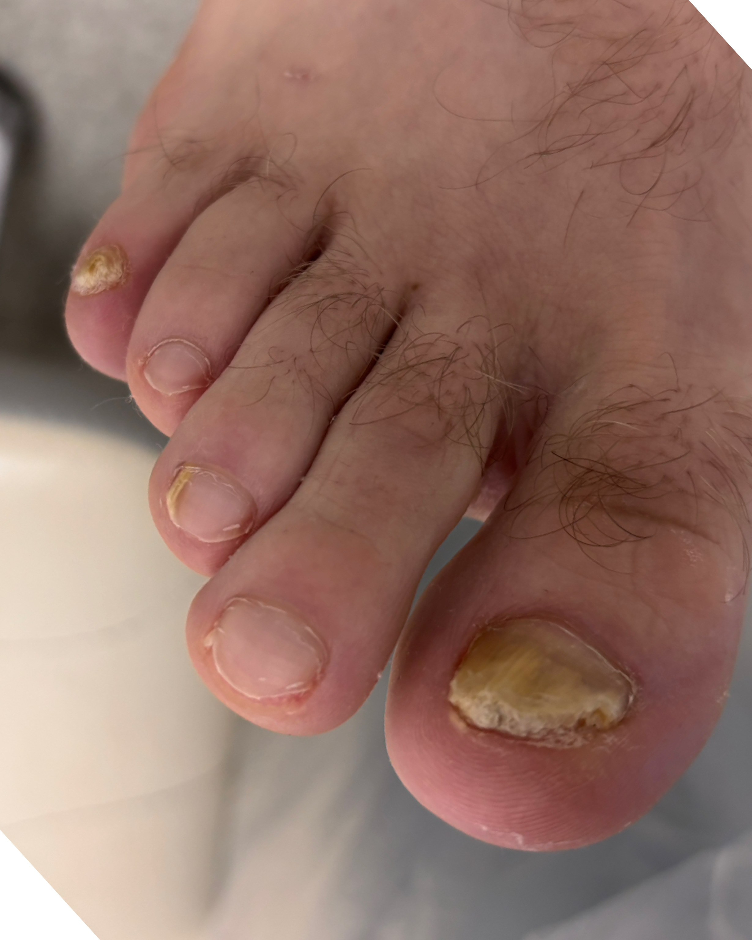 Обработка стопы при грибке. Подолог г. Хабаровск — центр здоровой стопы «FOOTTIME»