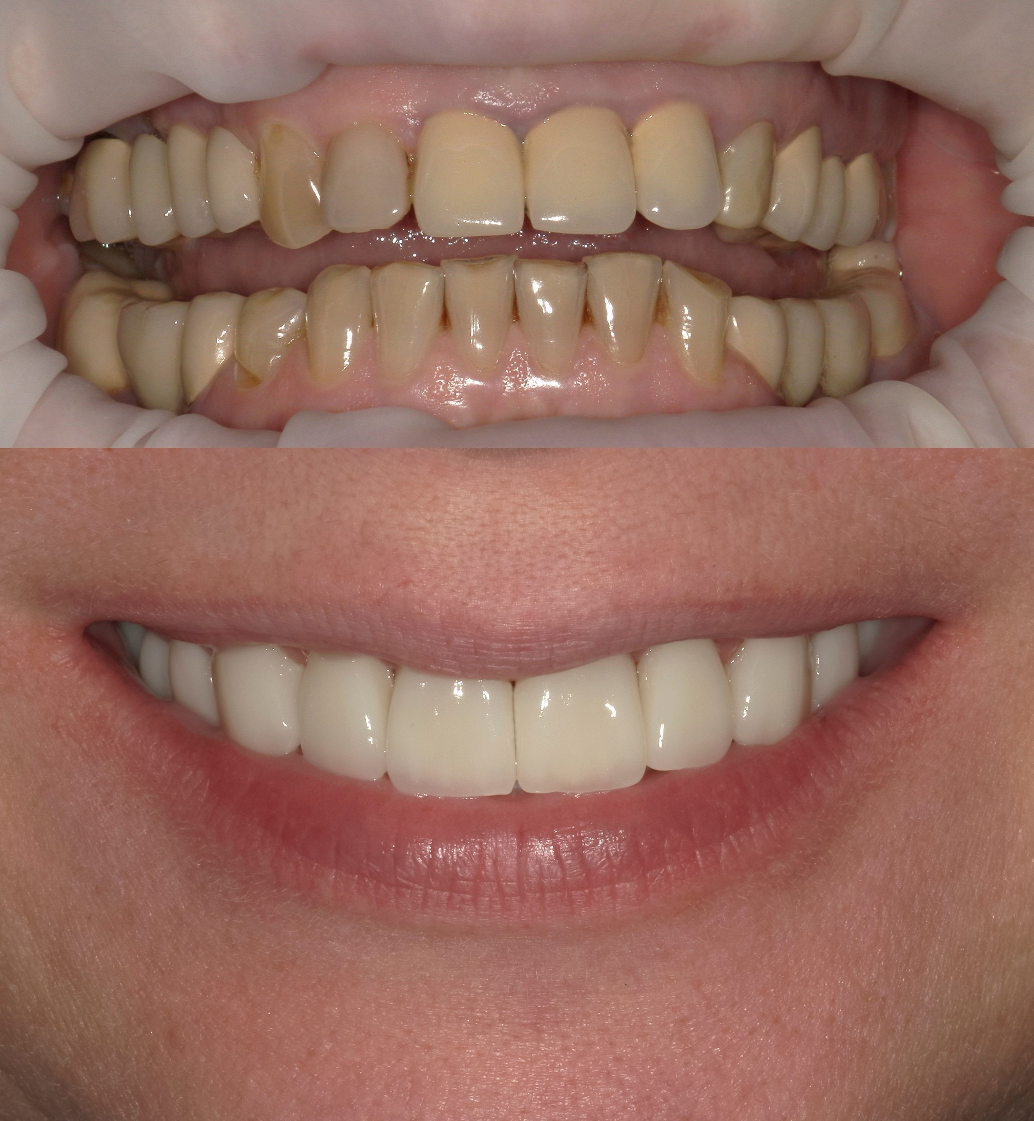 Создание улыбки мечты (виниры, коронки)