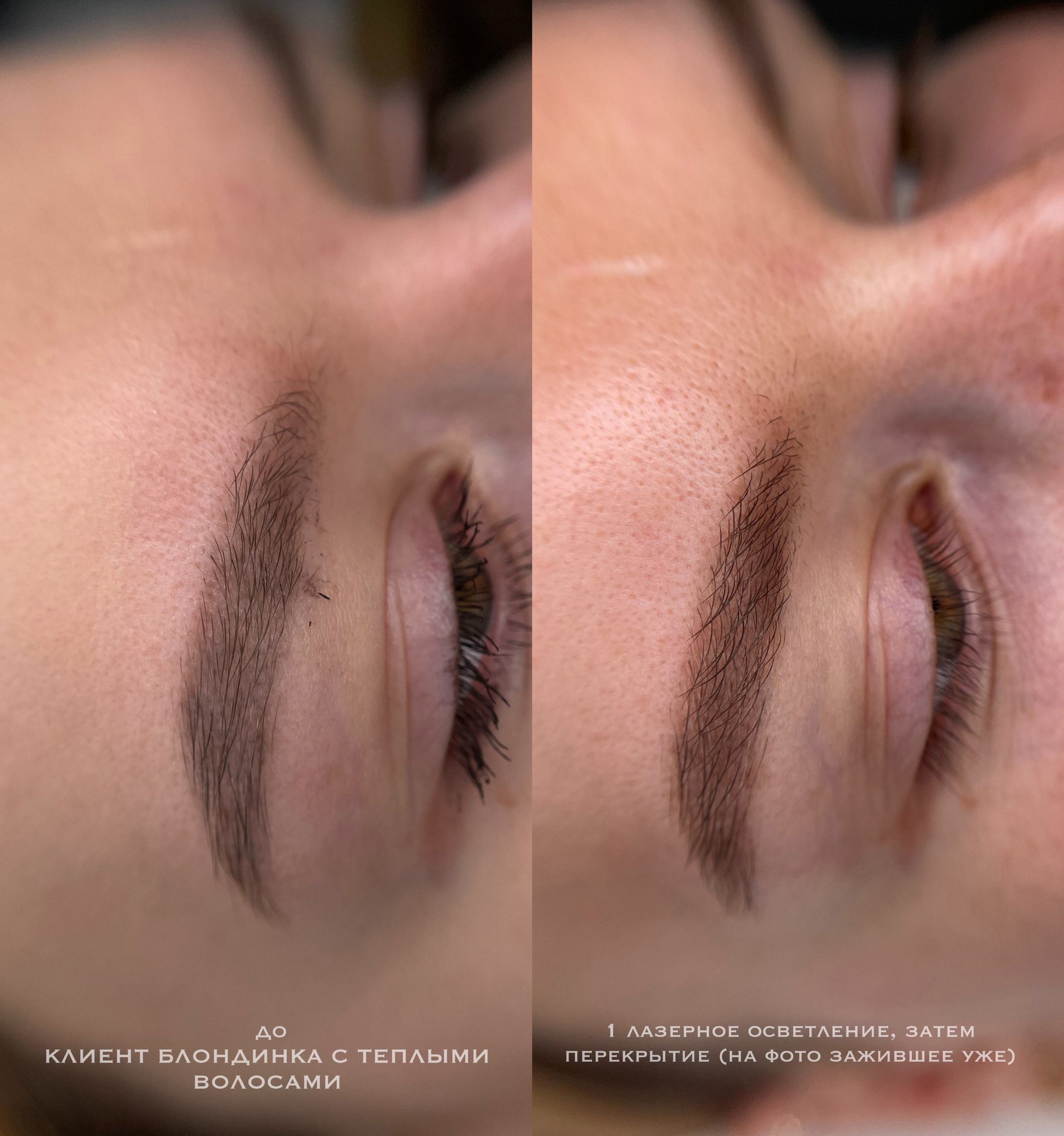 УДАЛЕНИЕ СТАРОГО ТАТУАЖА. Перманентный макияж и удаление старого татуажа в Ростове-на-Дону Дарья Исакова