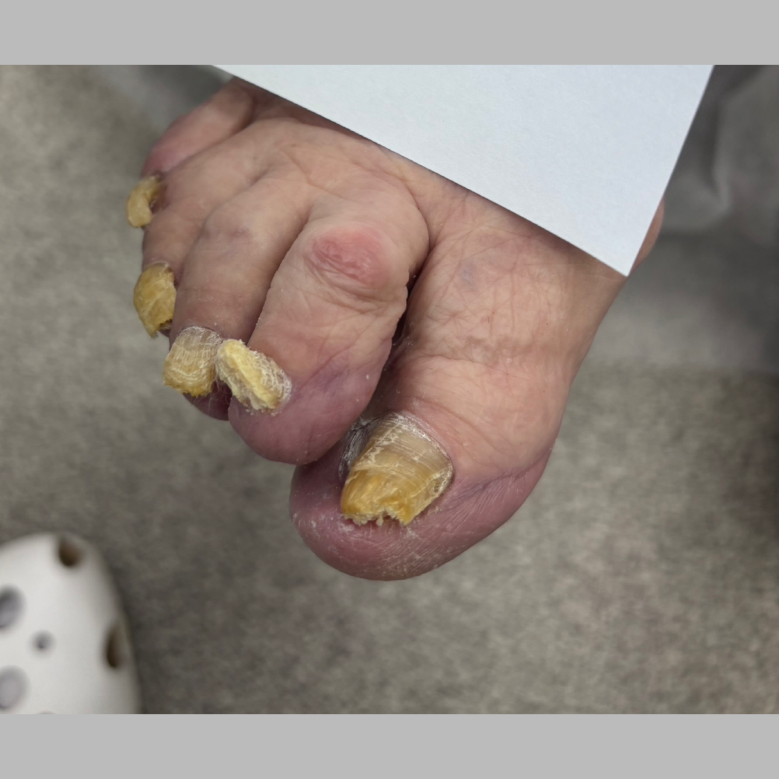 Тотальный онихомикоз. Подолог г. Хабаровск — центр здоровой стопы «FOOTTIME»