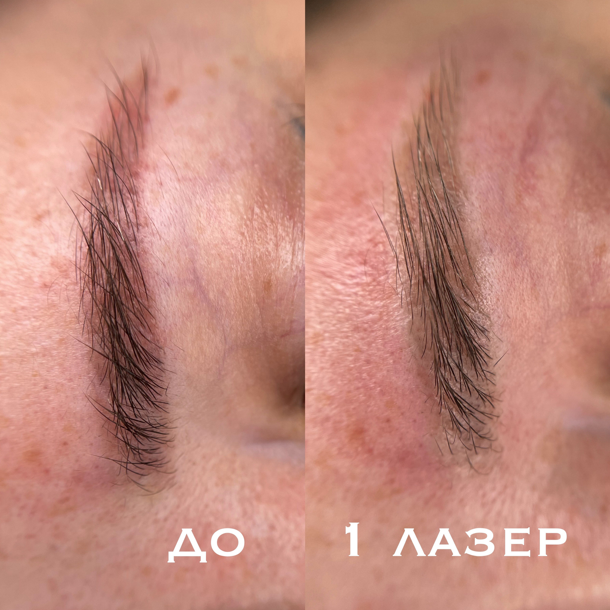 УДАЛЕНИЕ СТАРОГО ТАТУАЖА. Перманентный макияж и удаление старого татуажа в Ростове-на-Дону Дарья Исакова