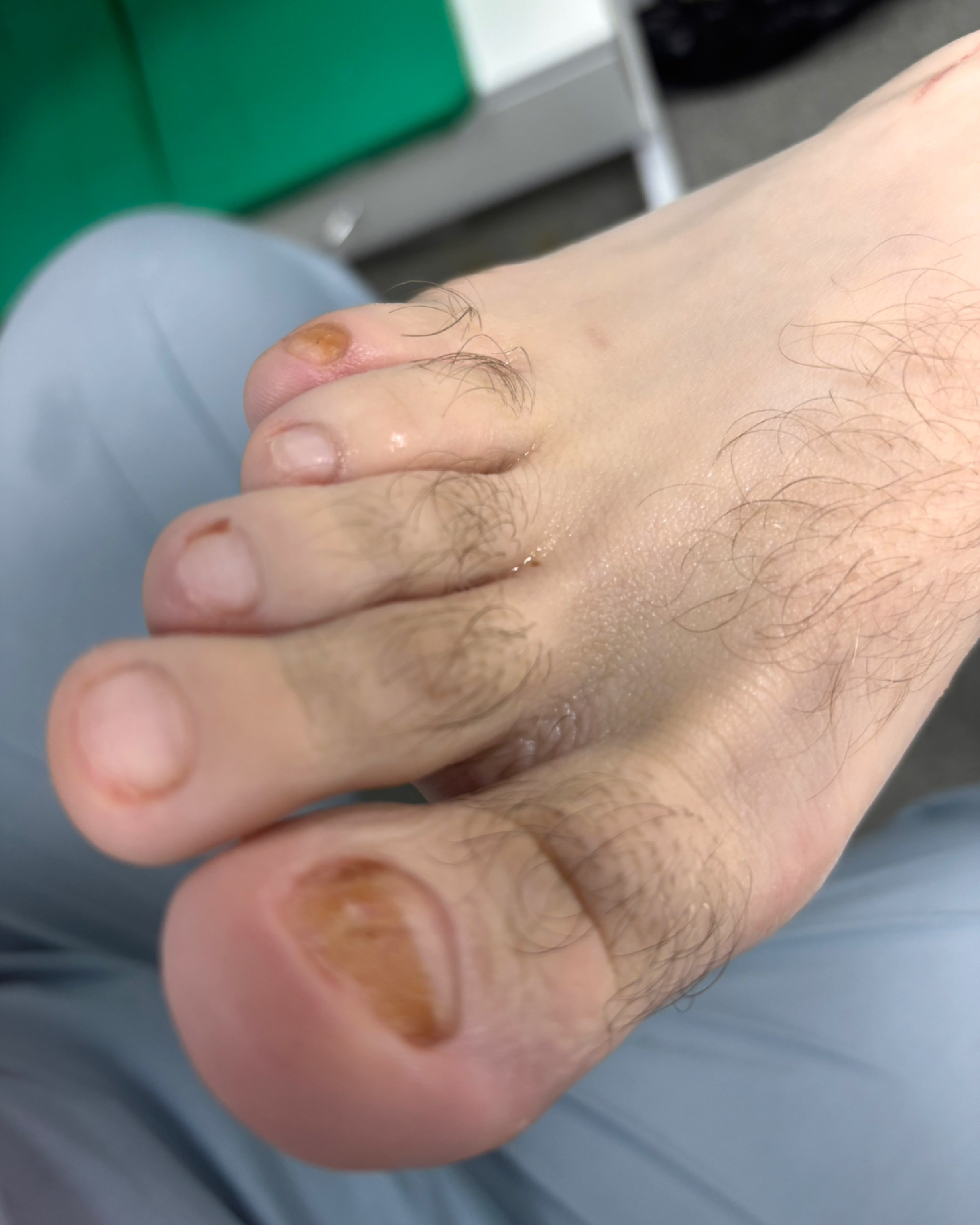 Обработка стопы при грибке. Подолог г. Хабаровск — центр здоровой стопы «FOOTTIME»