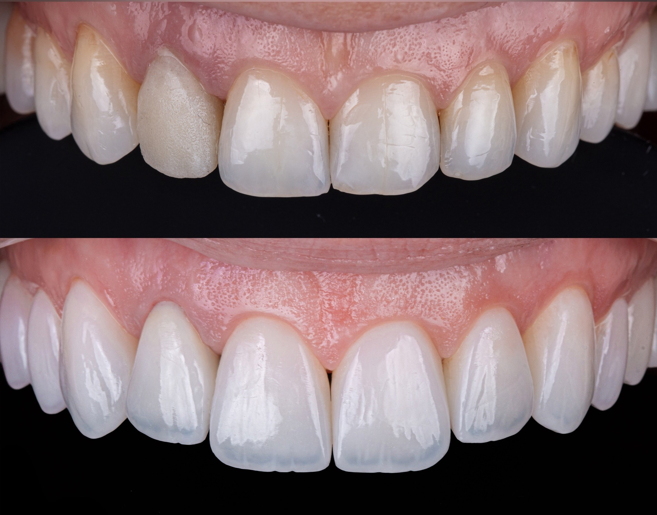 Замена композитных рествраций на виниры