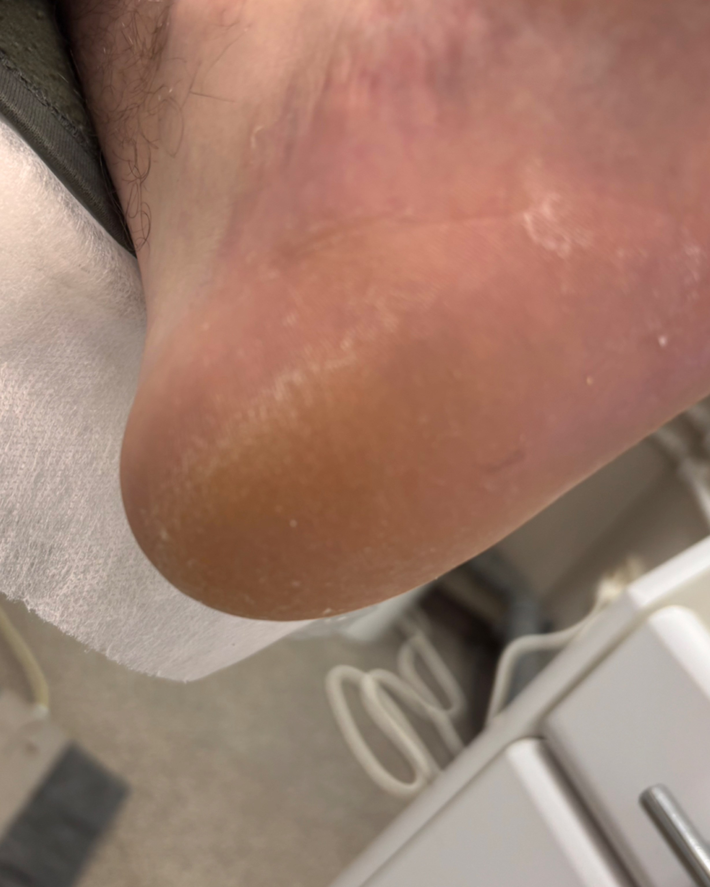 Обработка стопы при грибке. Подолог г. Хабаровск — центр здоровой стопы «FOOTTIME»