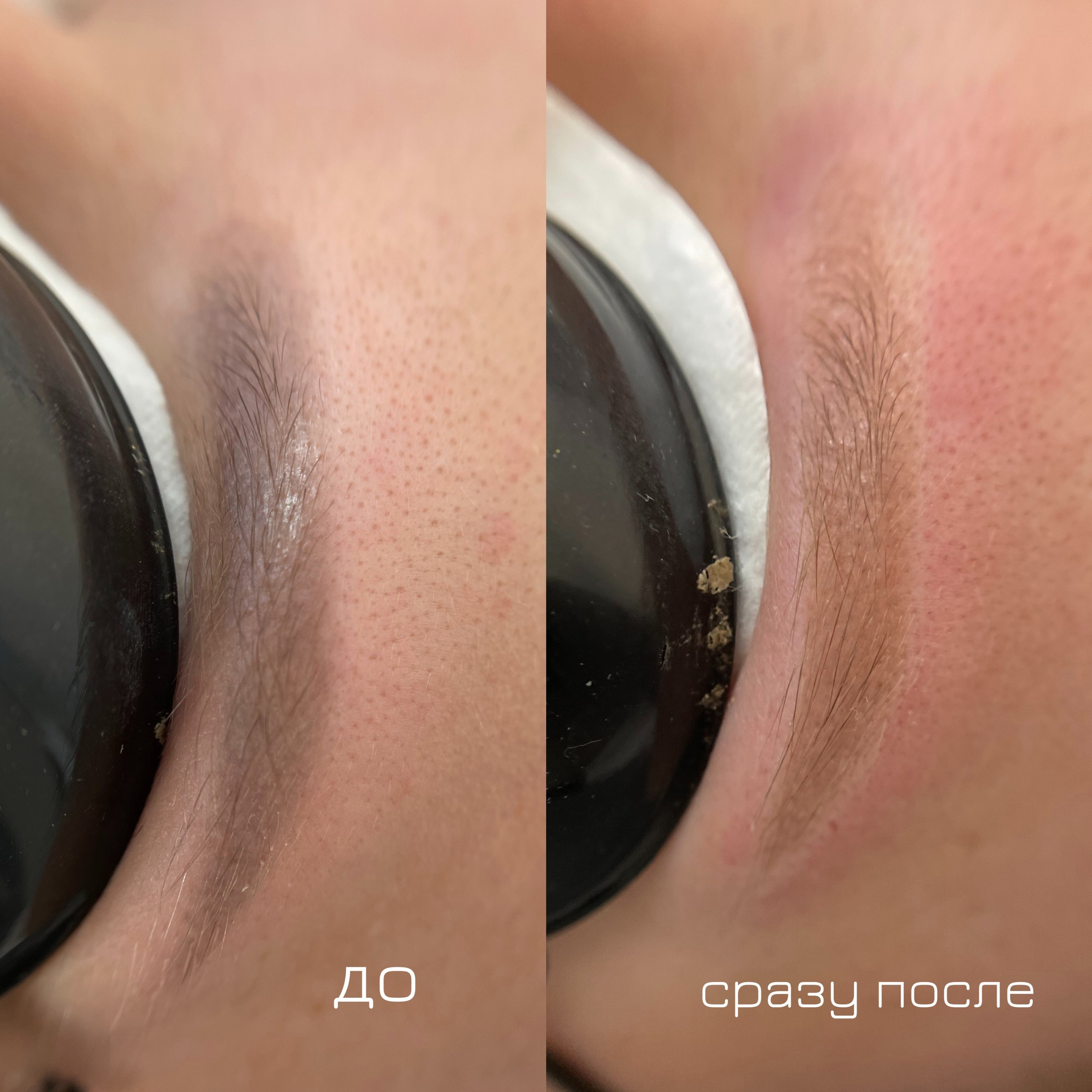 УДАЛЕНИЕ СТАРОГО ТАТУАЖА. Перманентный макияж и удаление старого татуажа в Ростове-на-Дону Дарья Исакова