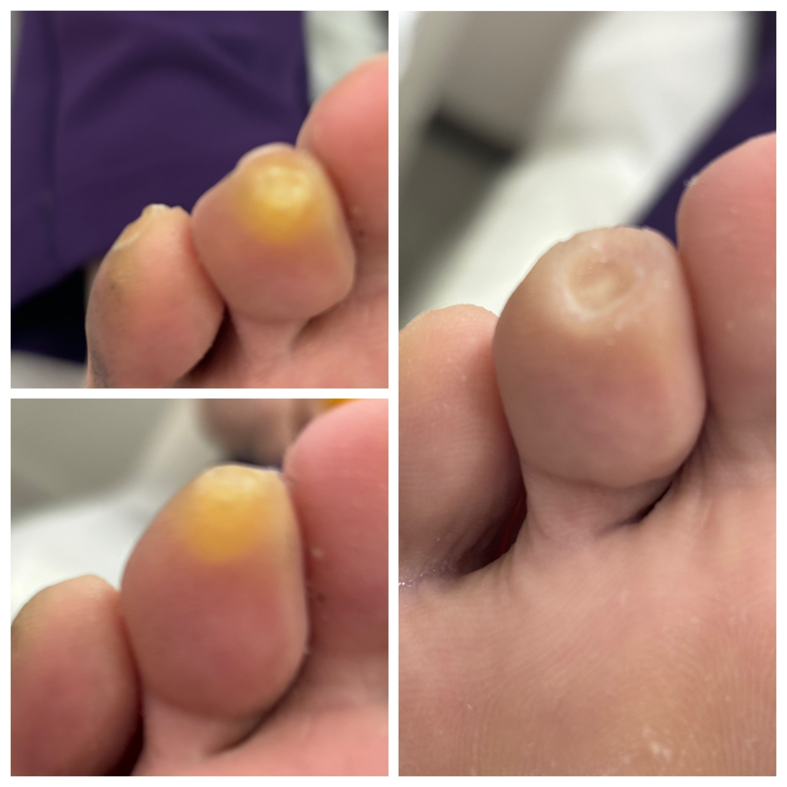 Обработка мозоли. Подолог г. Хабаровск — центр здоровой стопы «FOOTTIME»