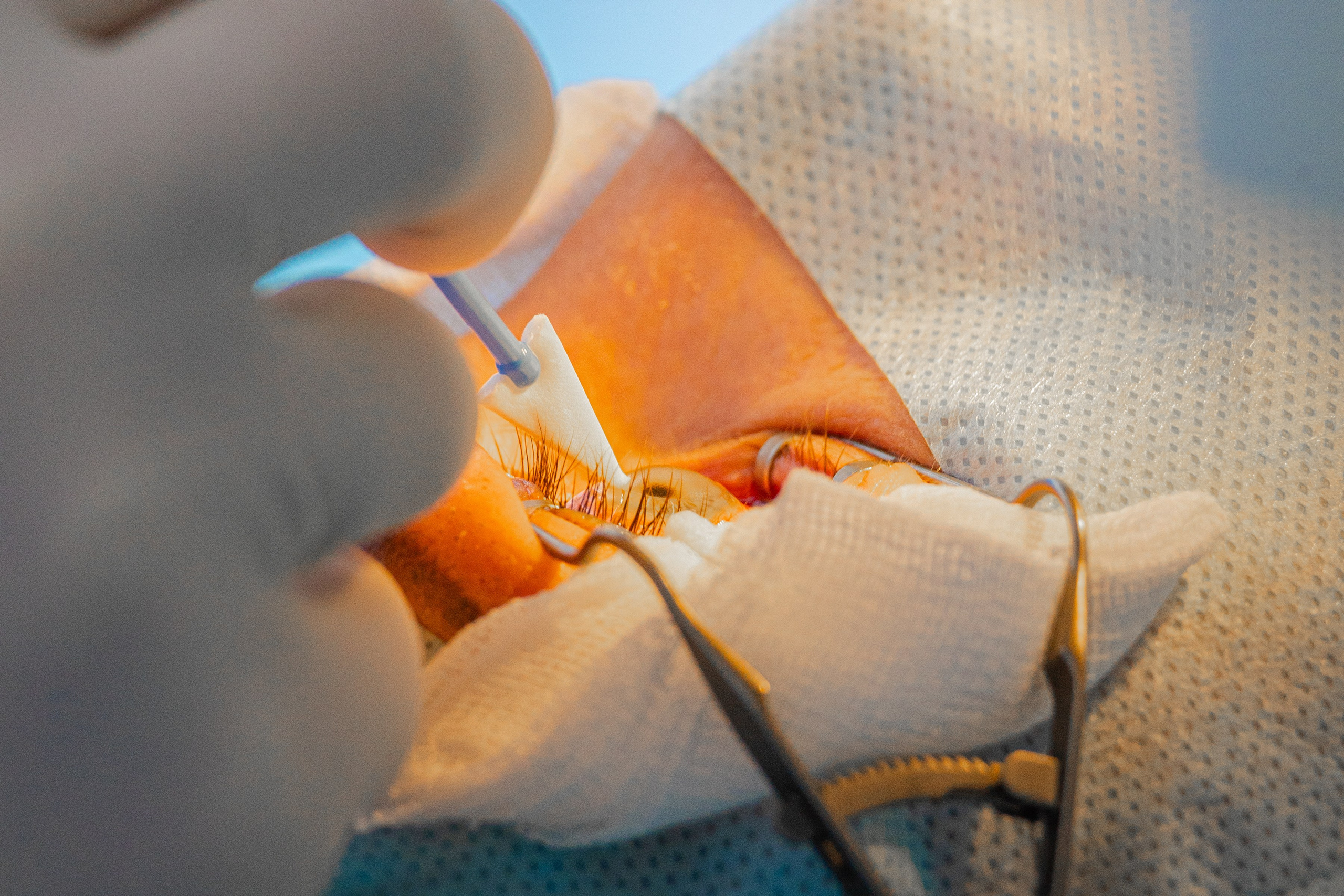 Глаз во время операции крупно близко 