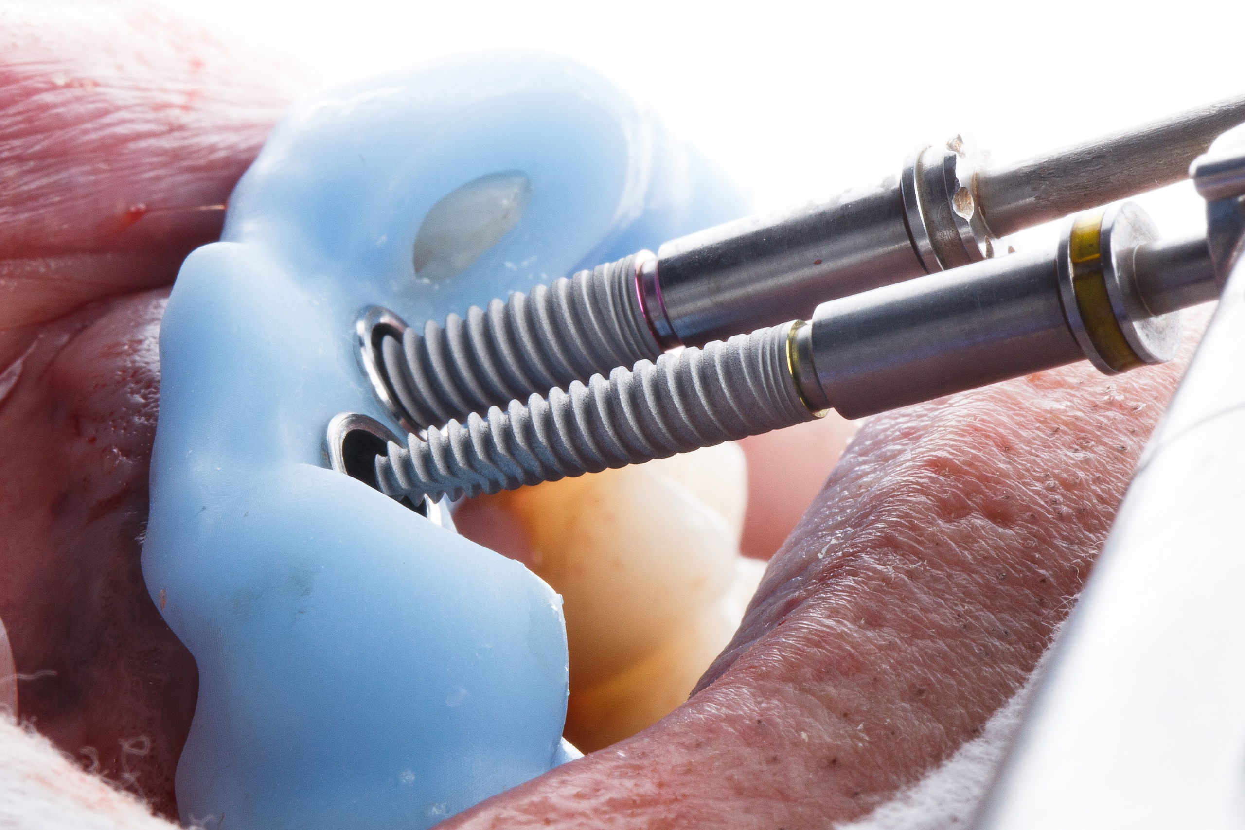 Хирургия. Дентал фотограф — видеограф Денис Дорошенко